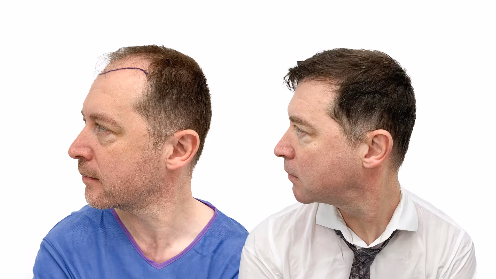 Brian – före och efter sin hårtransplantation
