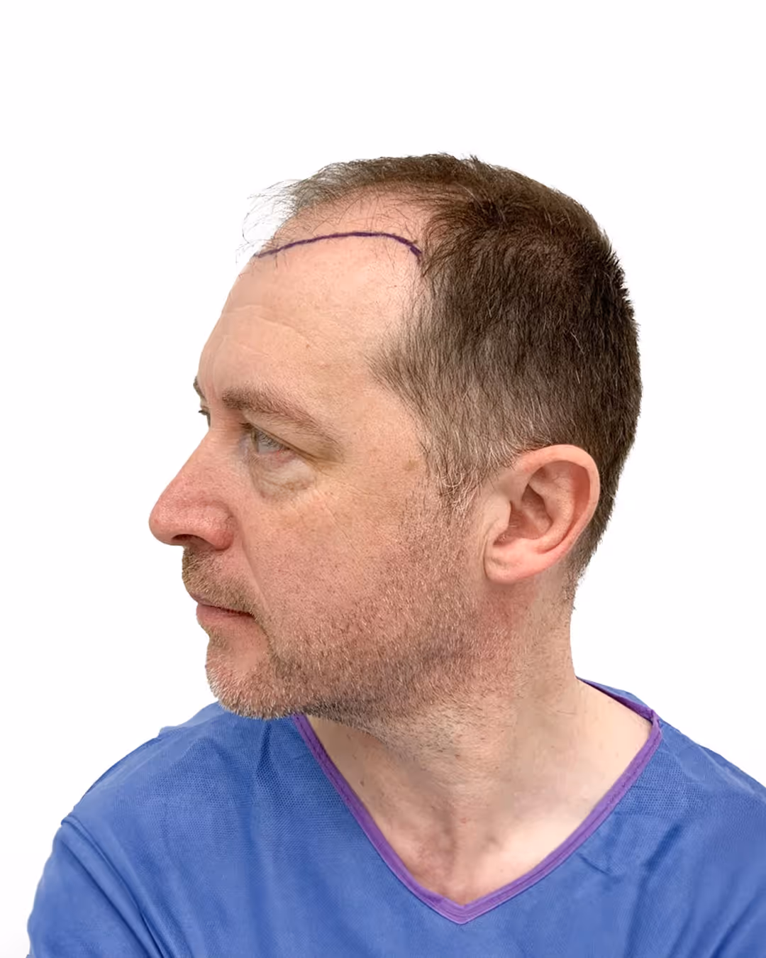 Brian före hårtransplantationen