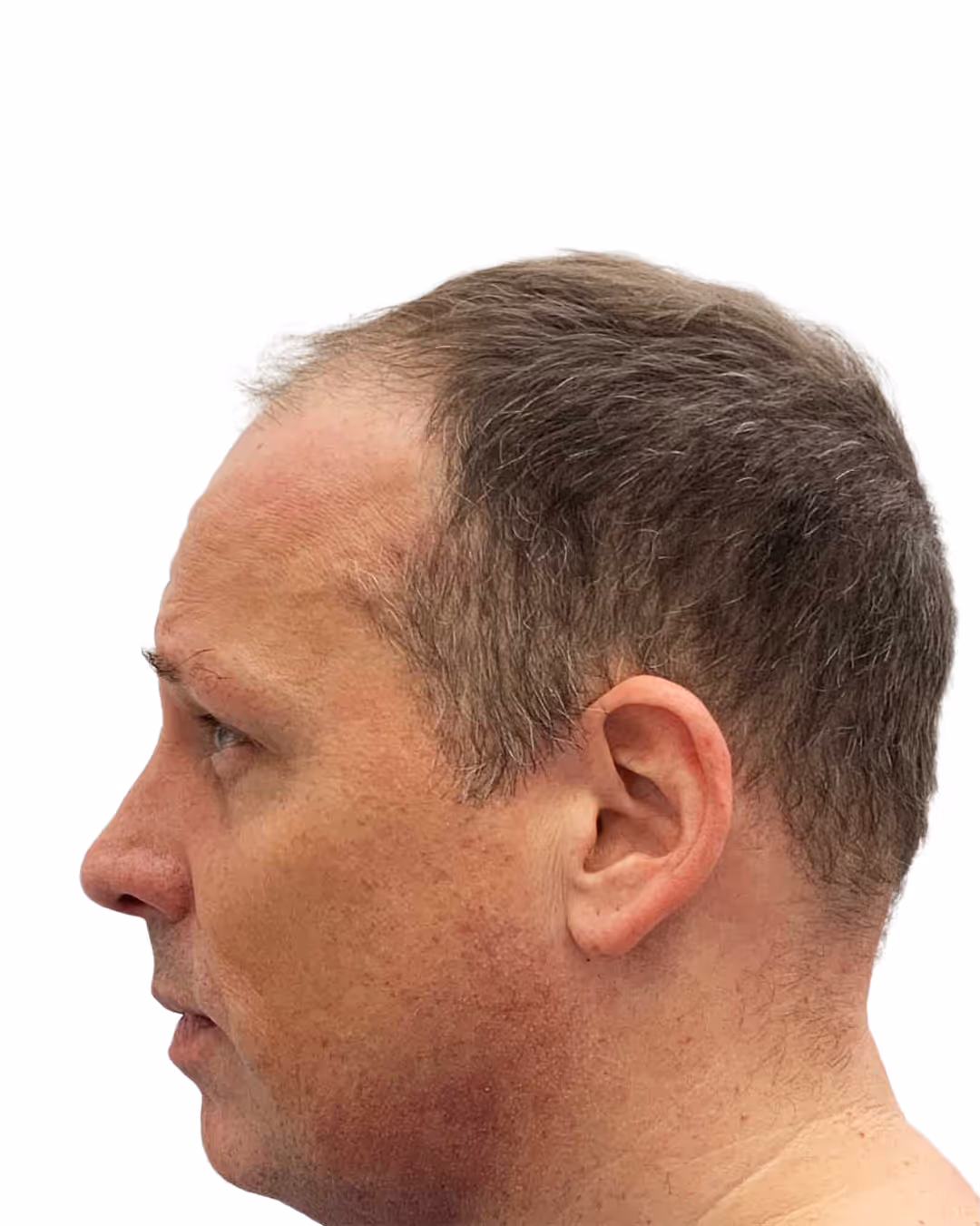 Benjamin före hårtransplantationen