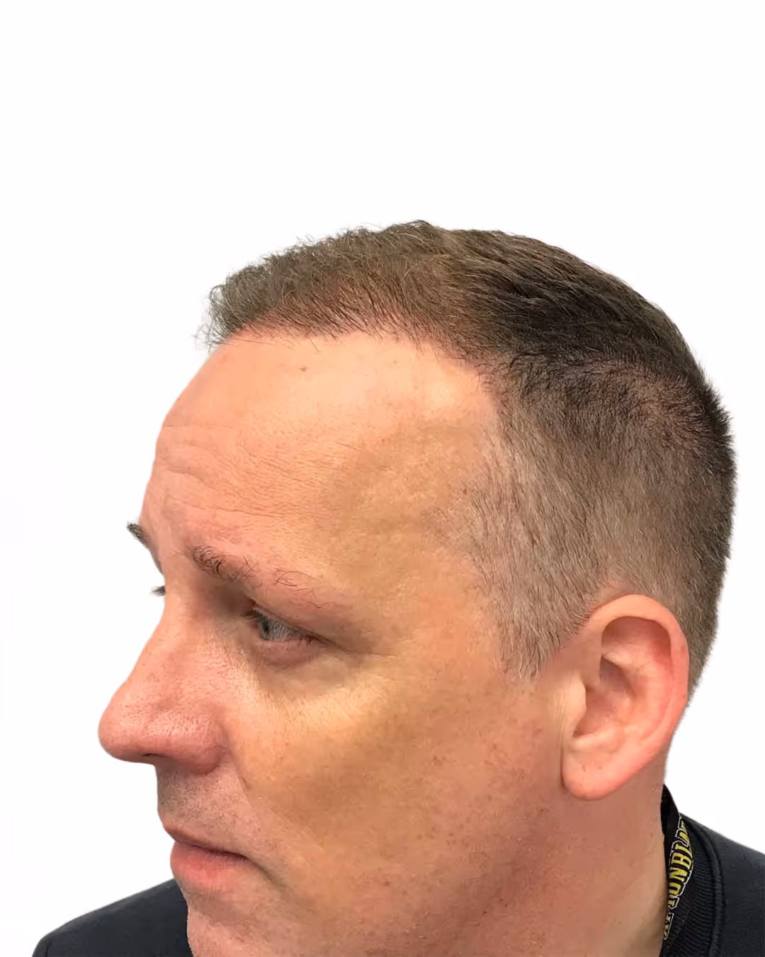 Benjamin efter hårtransplantationen
