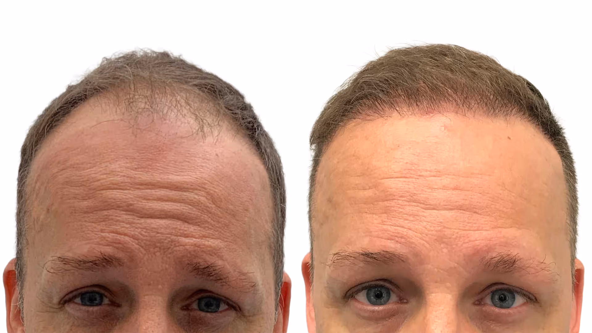 Benjamin – före och efter sin hårtransplantation