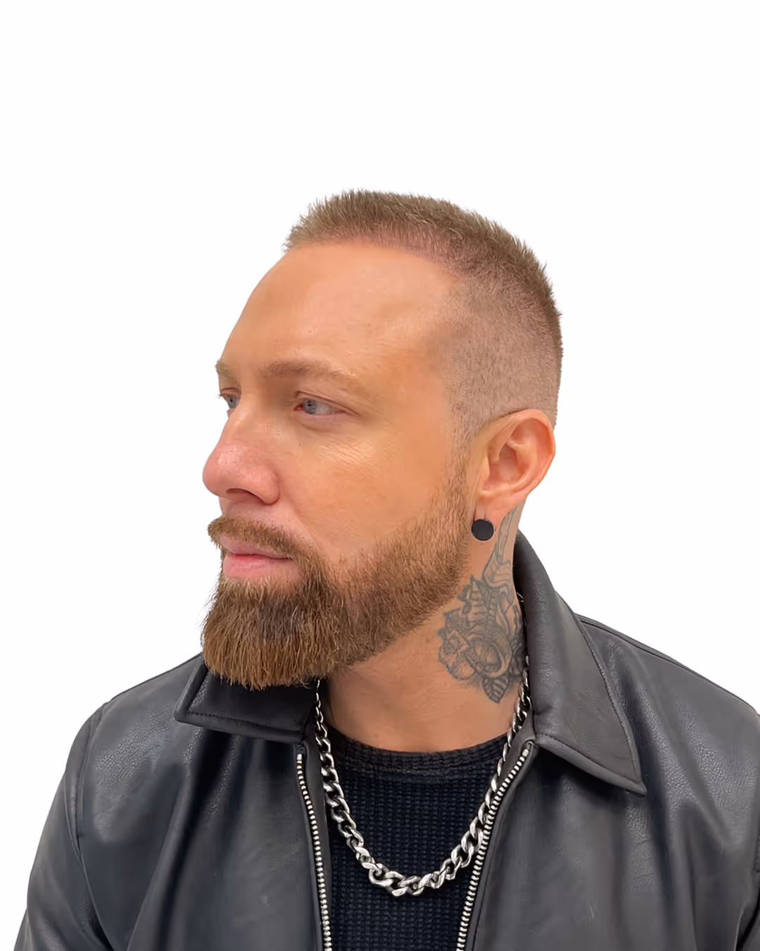 Benjamin efter hårtransplantationen