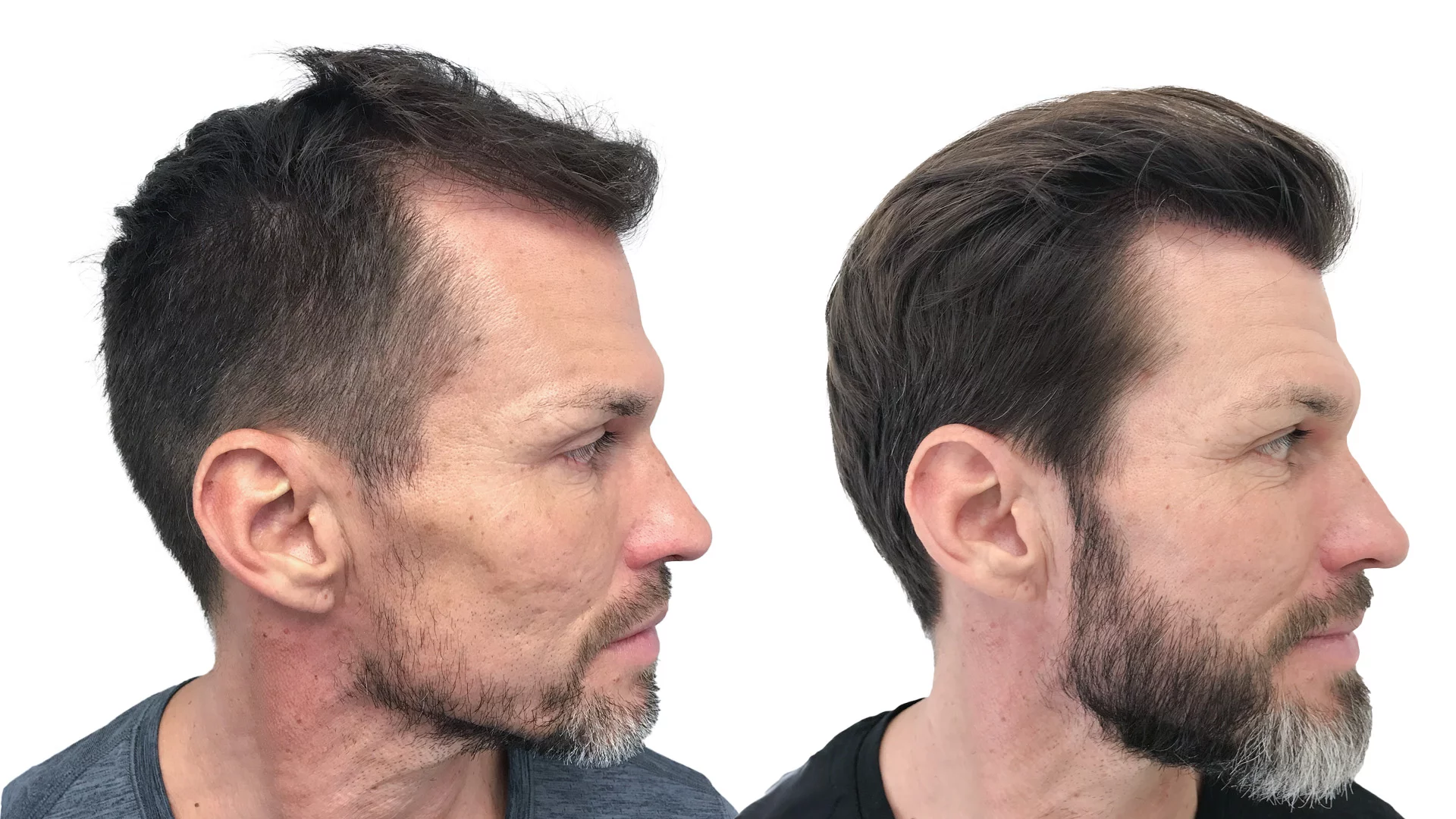 Ari – före och efter sin skäggtransplantation