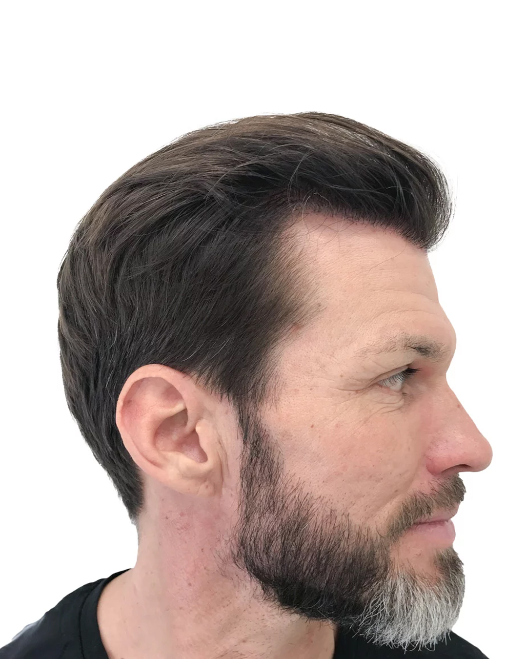 Ari efter skäggtransplantationen