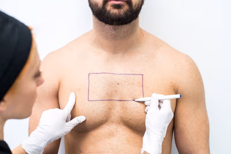 A man gets his chest drawn before a body hair transplant