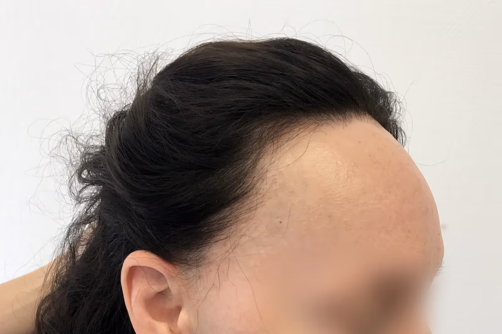 Female Frontal Fibros