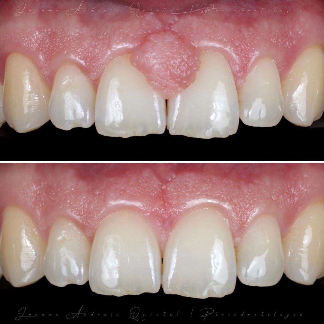 Comparação antes e depois de tratamento periodontal estético, mostrando correção do contorno gengival e melhoria da harmonia do sorriso.