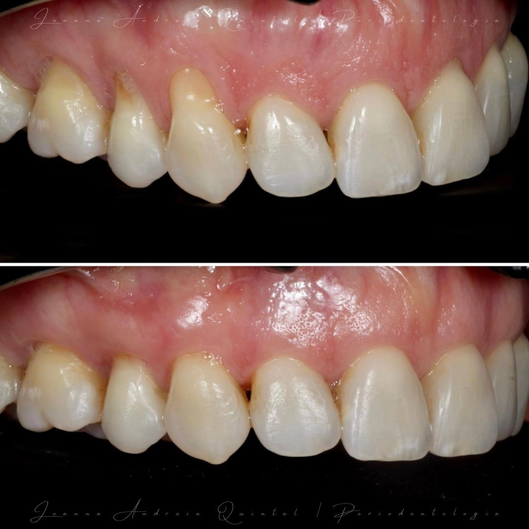 Comparação antes e depois de tratamento periodontal, mostrando melhoria da saúde gengival e estabilização dos tecidos de suporte dos dentes.