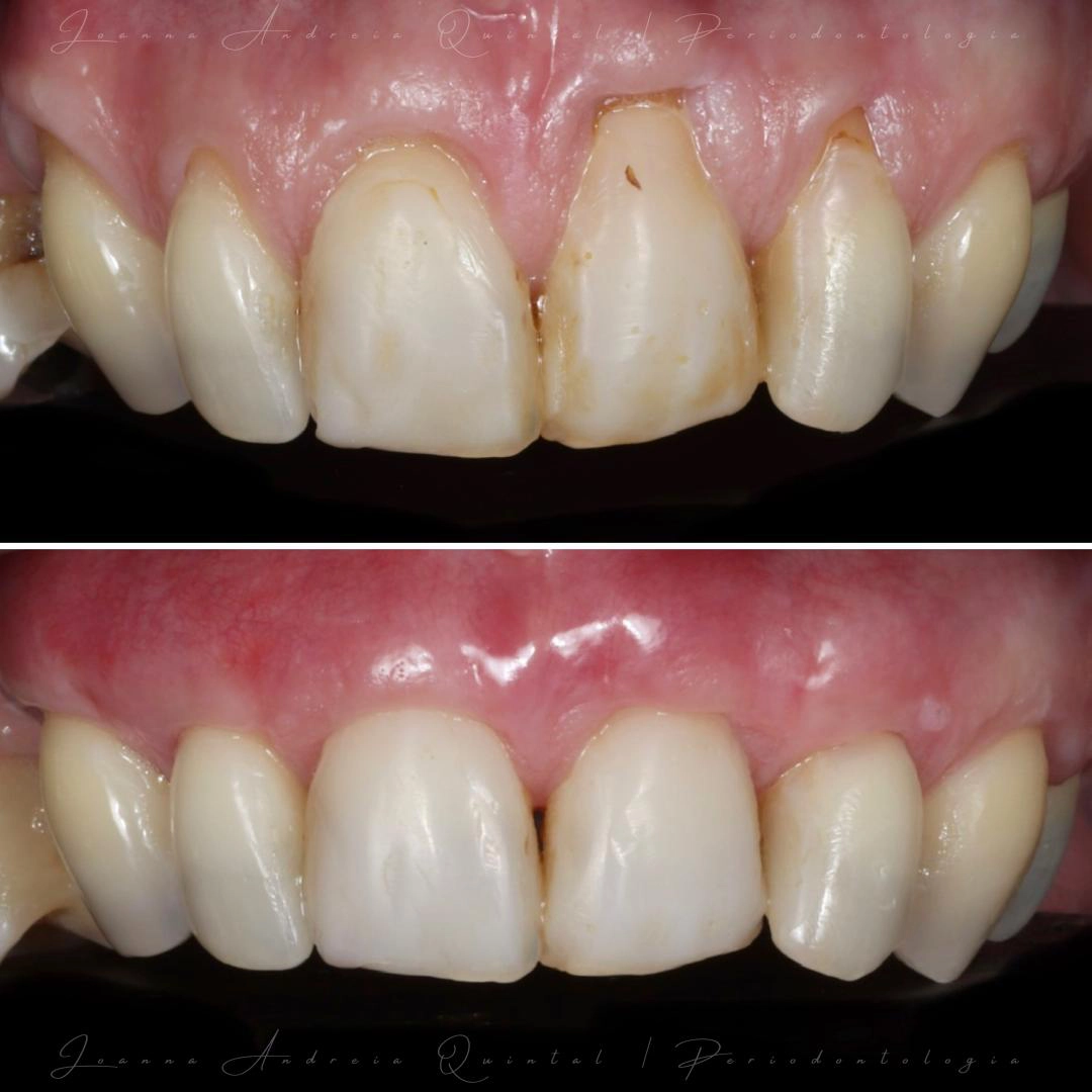 Comparação antes e depois de tratamento periodontal, mostrando melhoria da inflamação gengival, saúde dos tecidos de suporte e harmonia do sorriso.