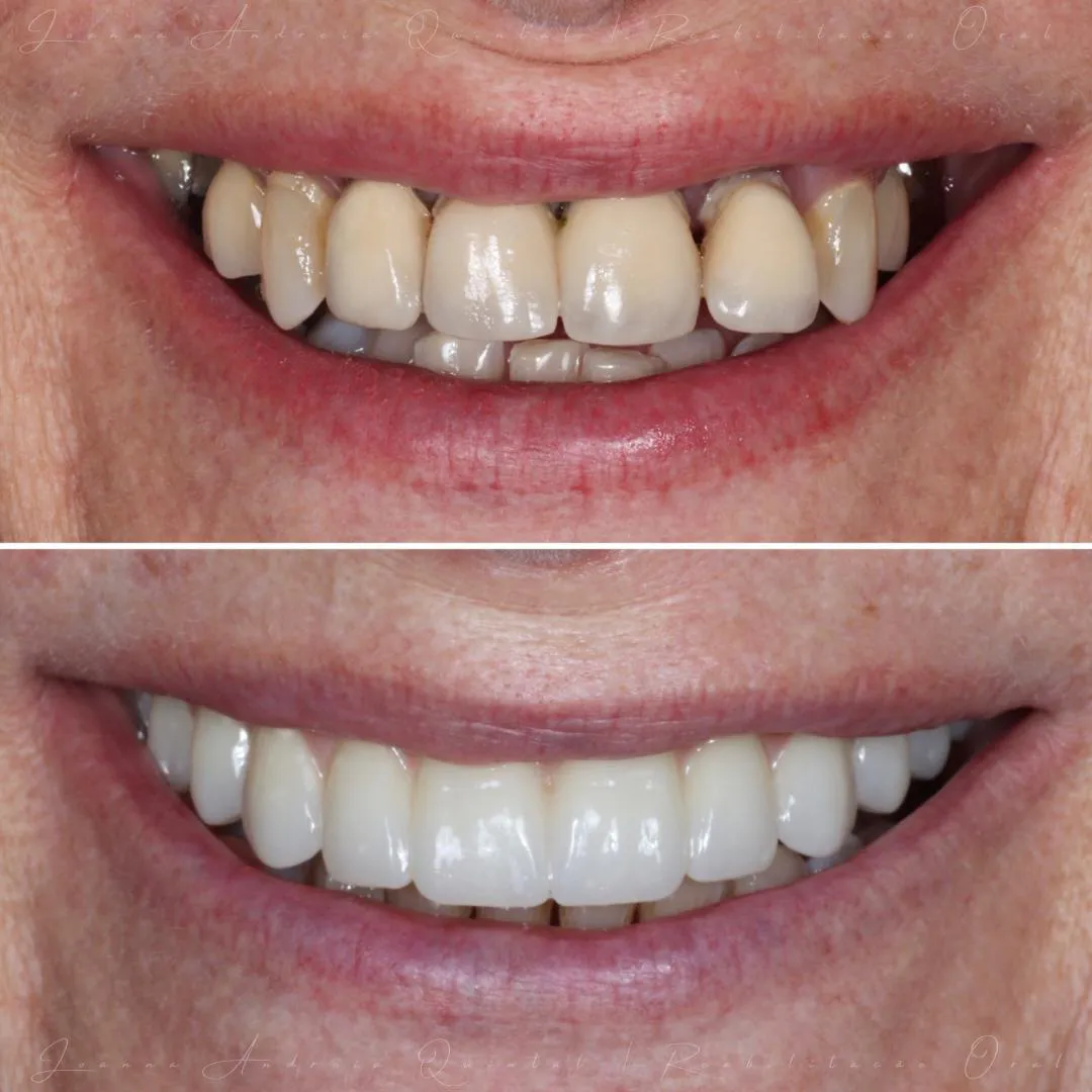 Comparação antes e depois de reabilitação estética com facetas dentárias, mostrando melhoria de cor, forma, alinhamento e harmonia do sorriso.