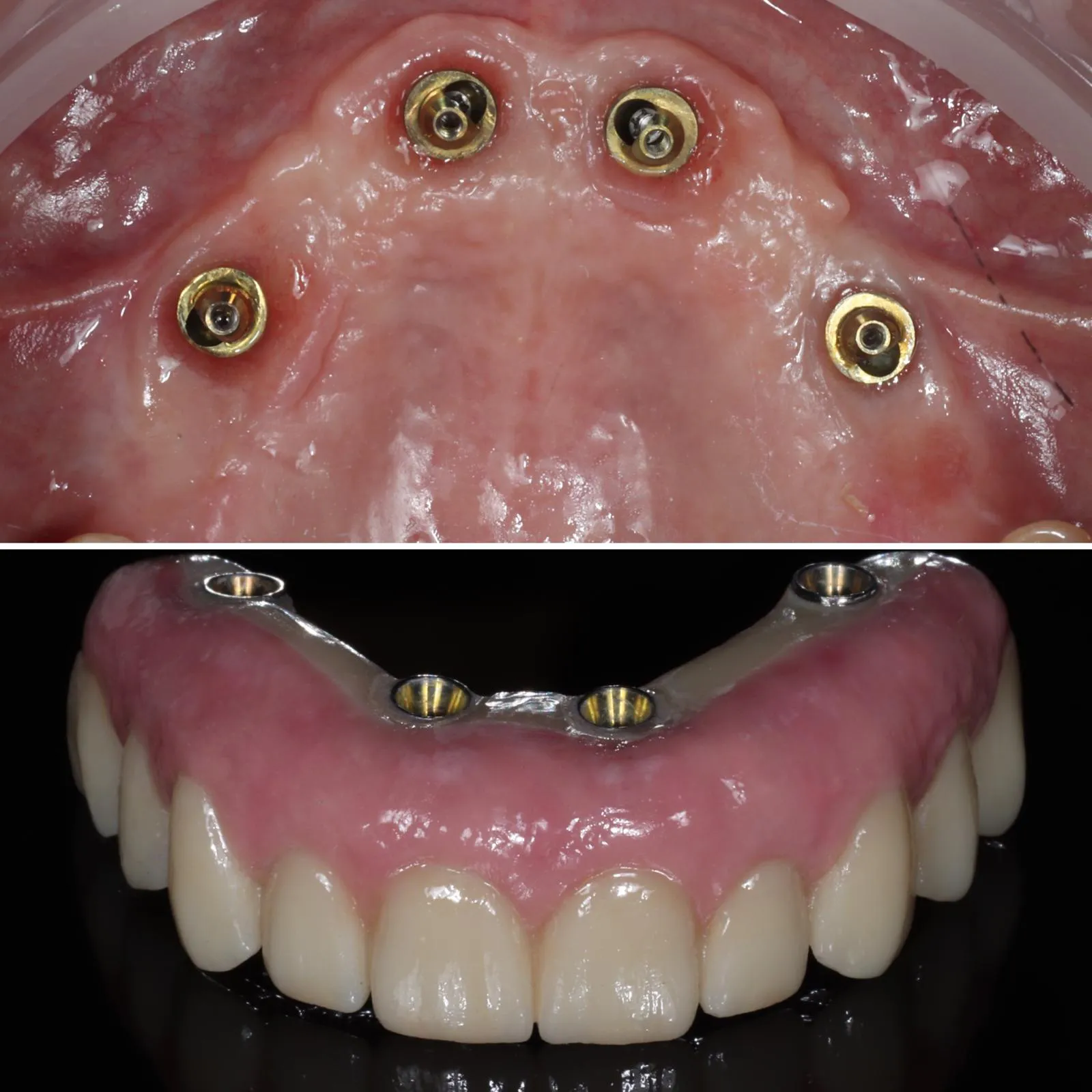 Vista intraoral de reabilitação fixa sobre implantes, mostrando pilares implantossuportados e prótese total com gengiva artificial para restauração funcional e estética.