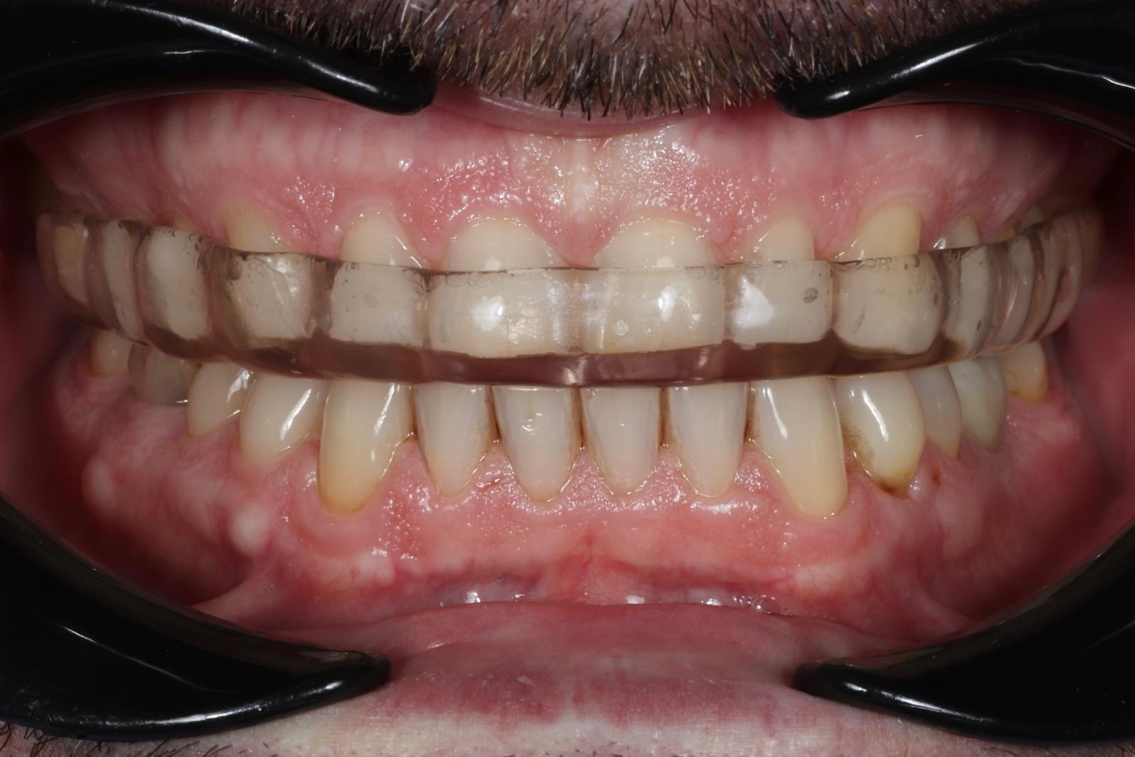Dispositivo intraoral de avanço mandibular em posição, utilizado no tratamento do bruxismo e dos distúrbios respiratórios do sono, com adaptação personalizada à arcada dentária.