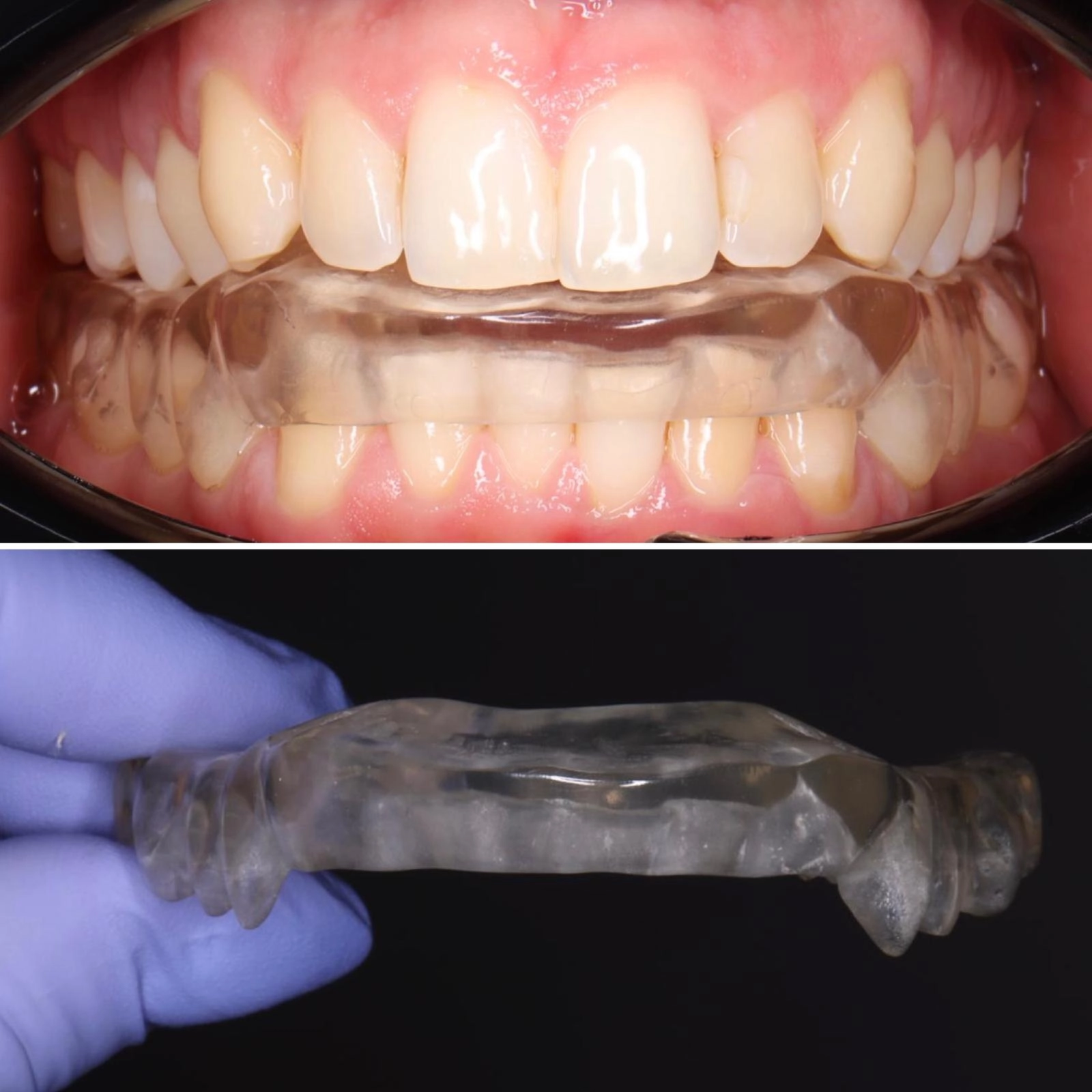 Placa oclusal personalizada em uso clínico para tratamento de disfunção temporomandibular (DTM), promovendo descompressão articular, equilíbrio oclusal e proteção dentária.