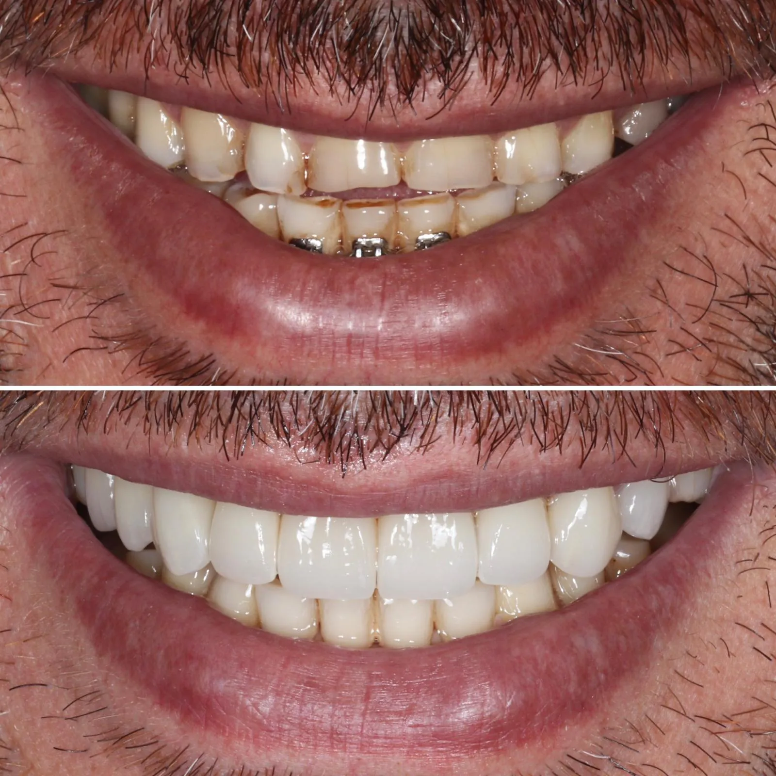 Comparação clínica do sorriso antes e após reabilitação estética com facetas dentárias, evidenciando melhoria da cor, forma e harmonia do sorriso.