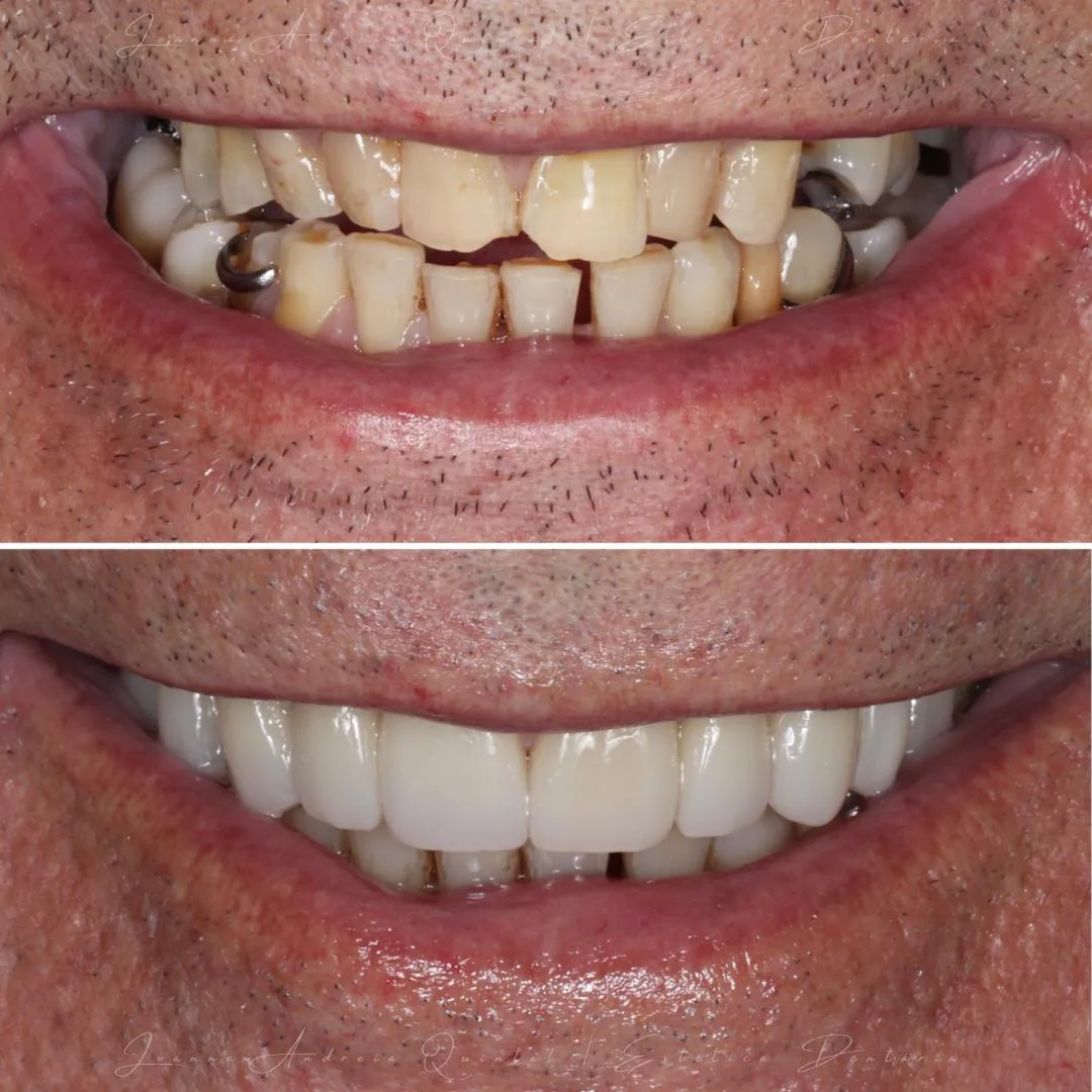 Comparação antes e depois de reabilitação estética com facetas dentárias, mostrando correção de forma, cor e alinhamento para um sorriso mais harmonioso e funcional.