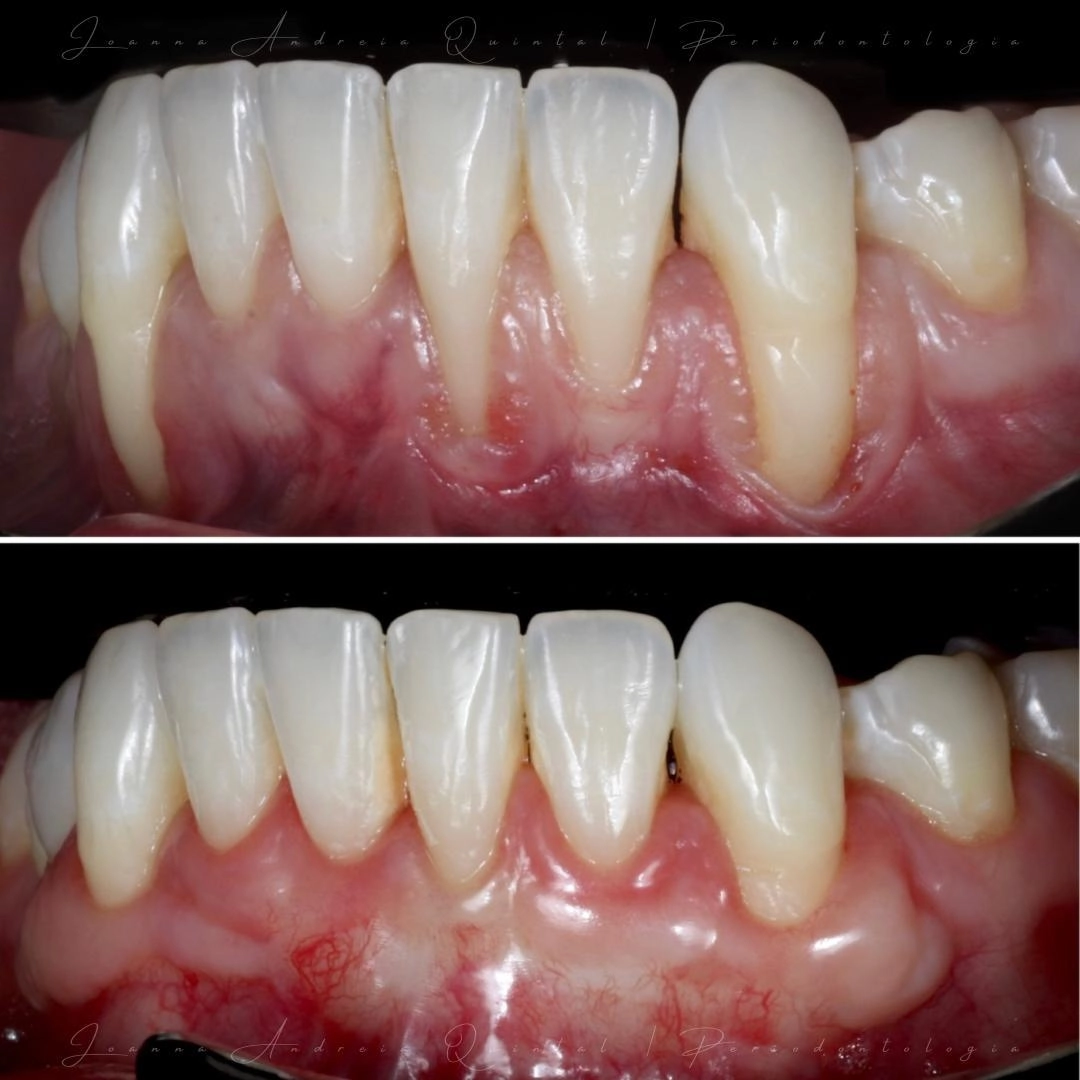 Comparação antes e depois de tratamento periodontal, mostrando redução da inflamação gengival, melhoria do contorno gengival e tecidos mais saudáveis.