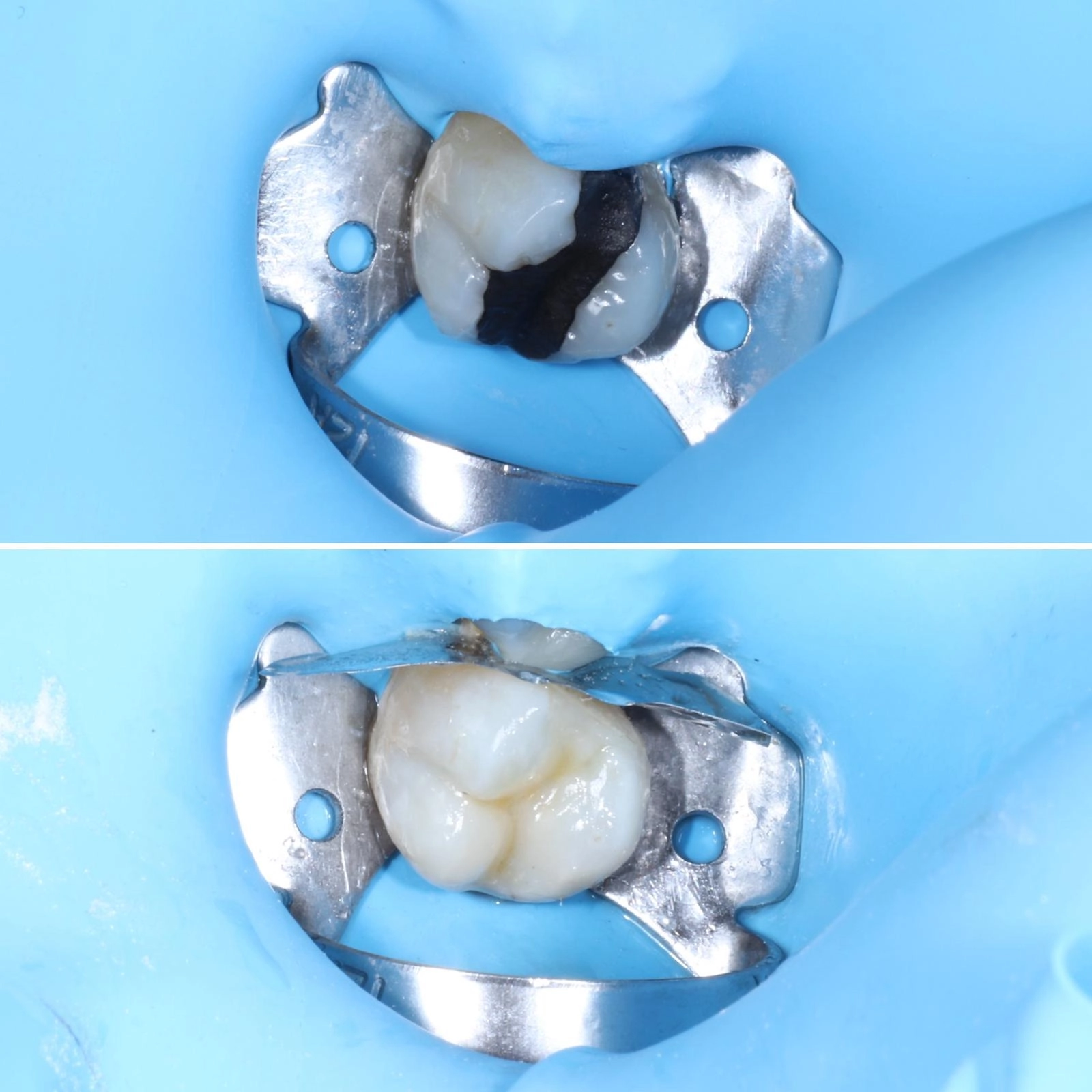 Detalhe de tratamento restaurador com isolamento absoluto para maior segurança clínica.
