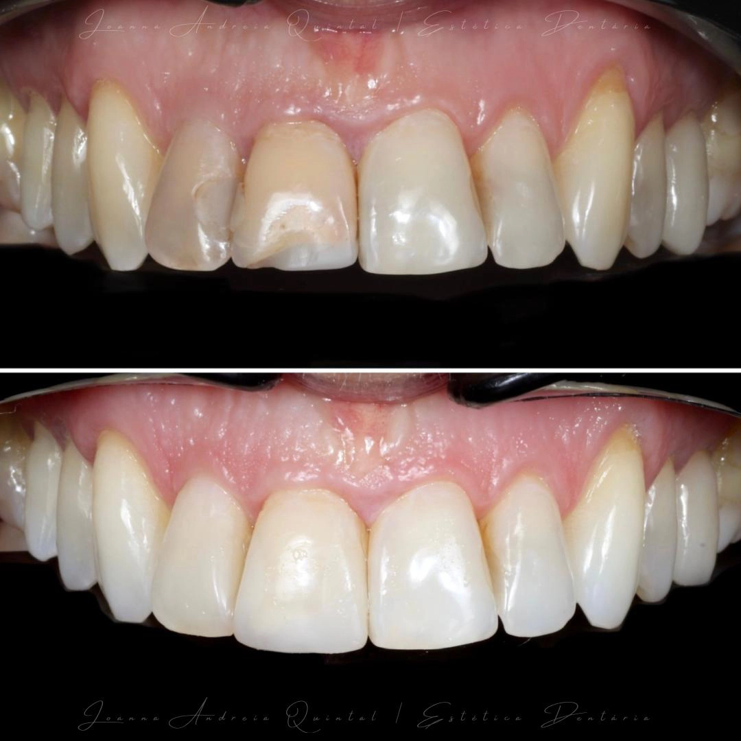 Resultado clínico antes e depois de tratamento dentário com foco na saúde gengival e estética.