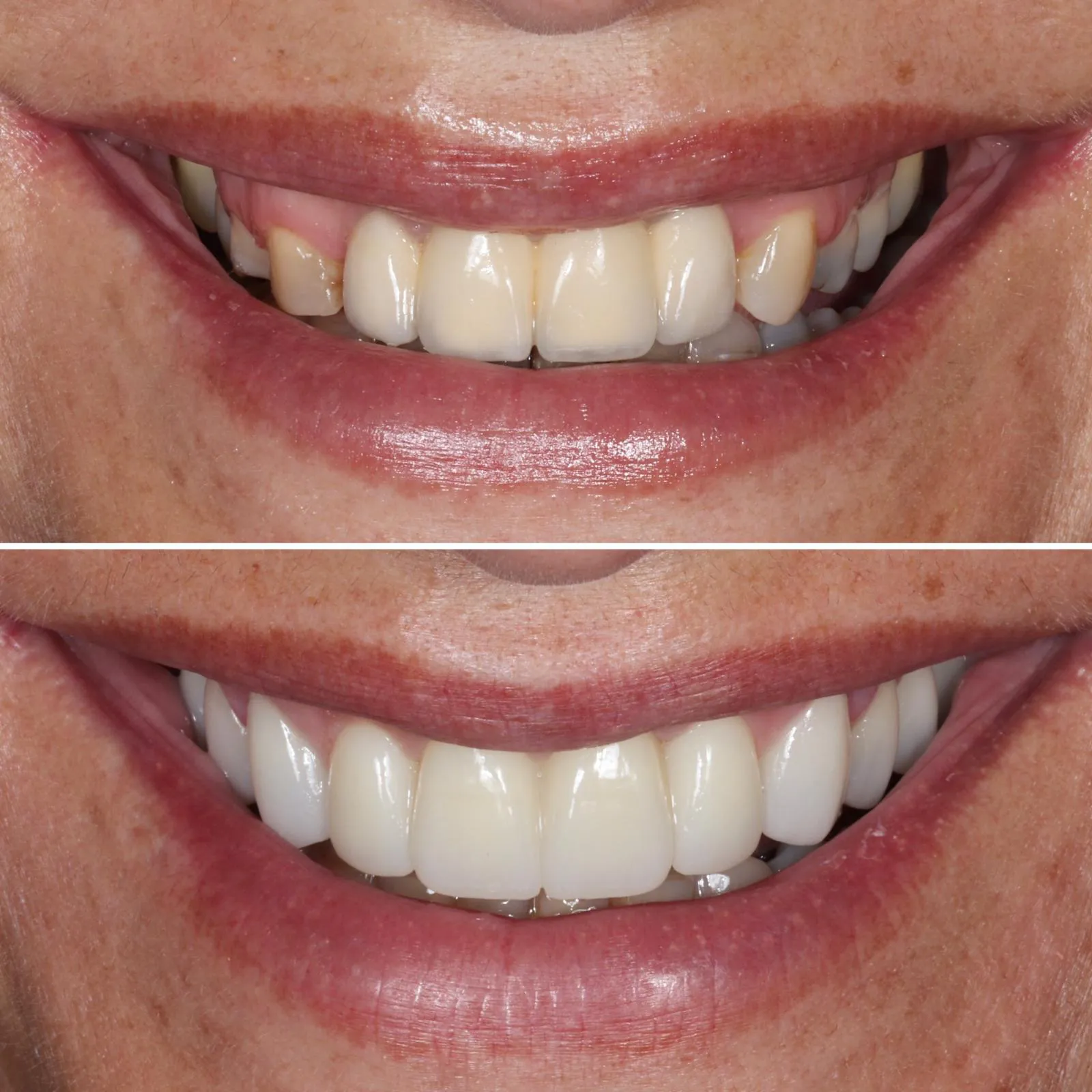 Comparação antes e depois de tratamento de estética dentária com facetas, evidenciando melhoria da cor, forma e alinhamento dos dentes anteriores.