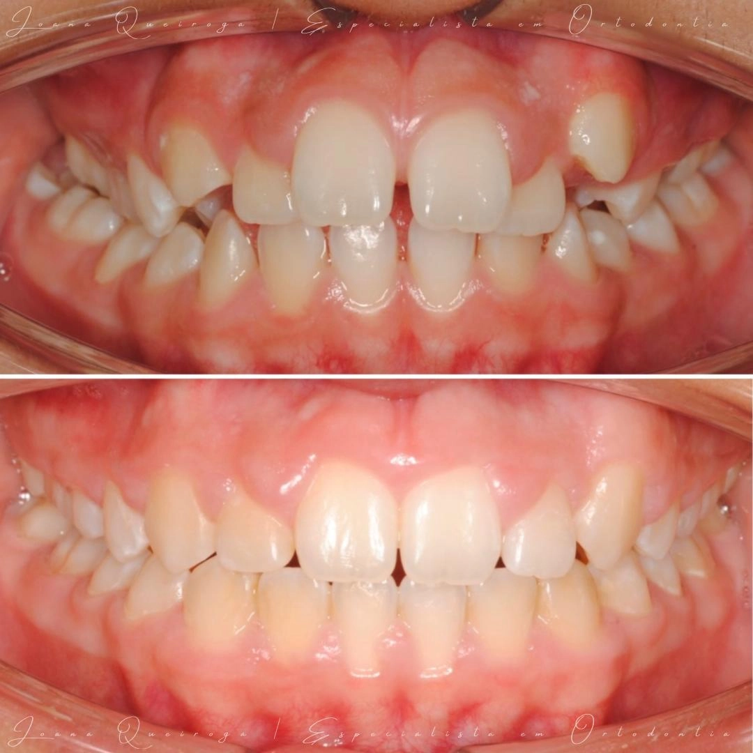 Antes e depois de tratamento ortodôntico, mostrando correção do alinhamento dentário e melhoria da mordida frontal.