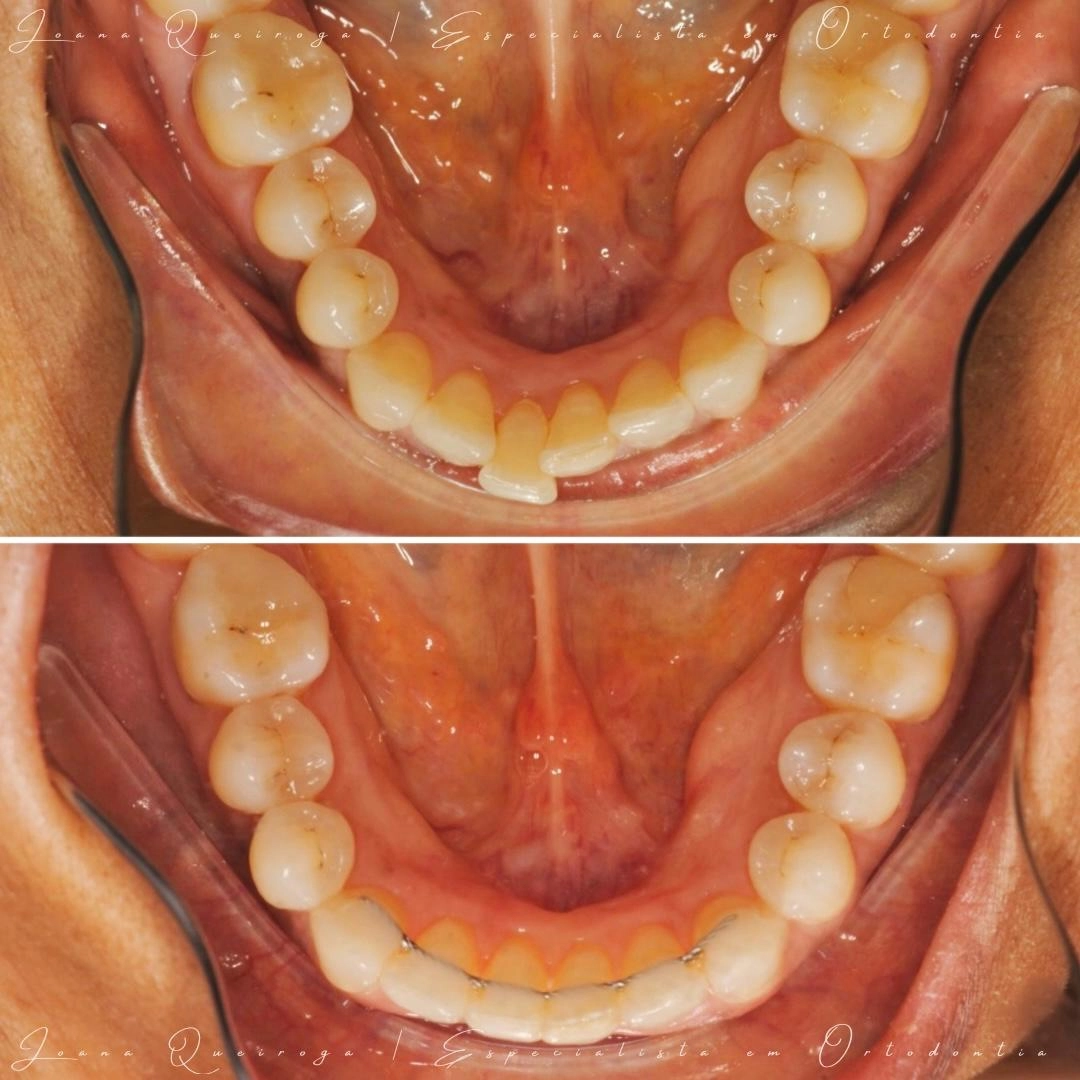 Vista intraoral inferior antes e após tratamento ortodôntico, mostrando alinhamento dos dentes mandibulares e colocação de contenção fixa.