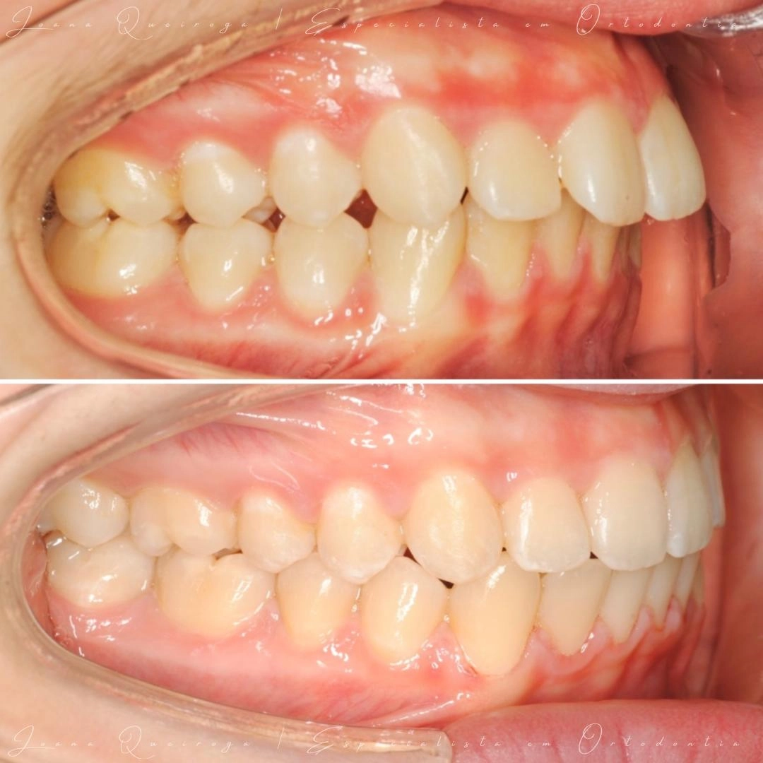 Vista intraoral lateral antes e após tratamento ortodôntico, mostrando correção da oclusão e alinhamento dentário.