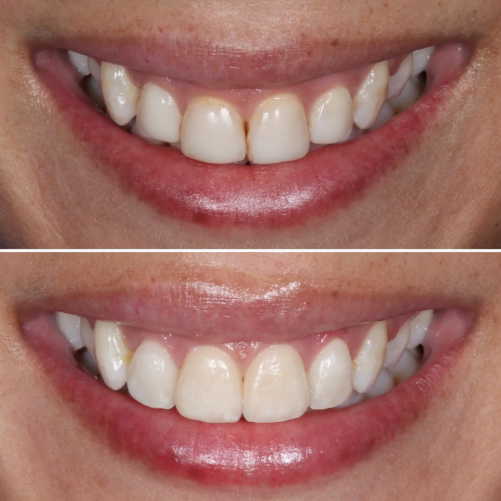 Comparação antes e depois de facetas dentárias anteriores, mostrando melhoria de forma, cor e alinhamento do sorriso com resultado natural.