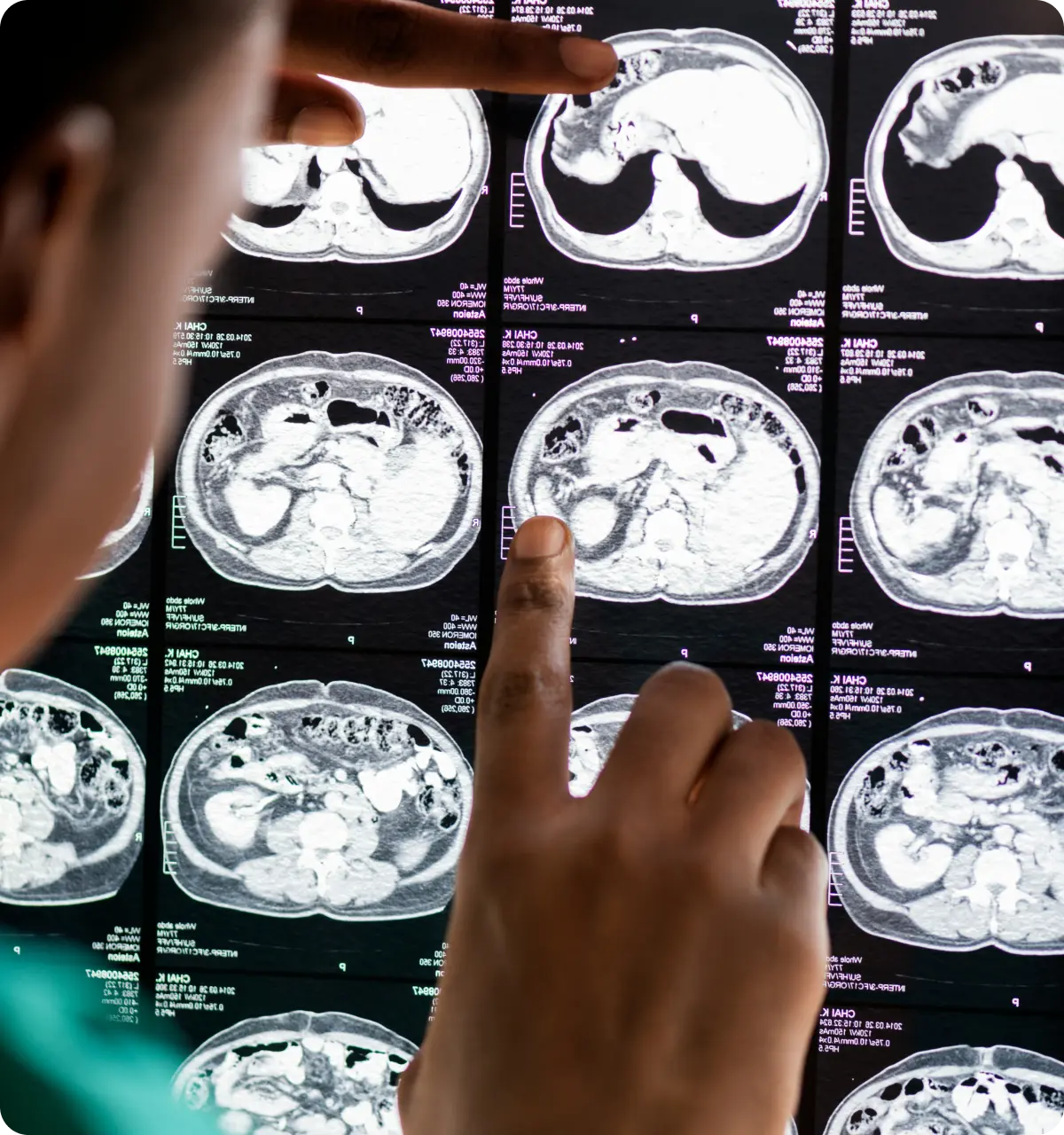 A person pointing at abdominal CT scan images displayed on a medical screen.