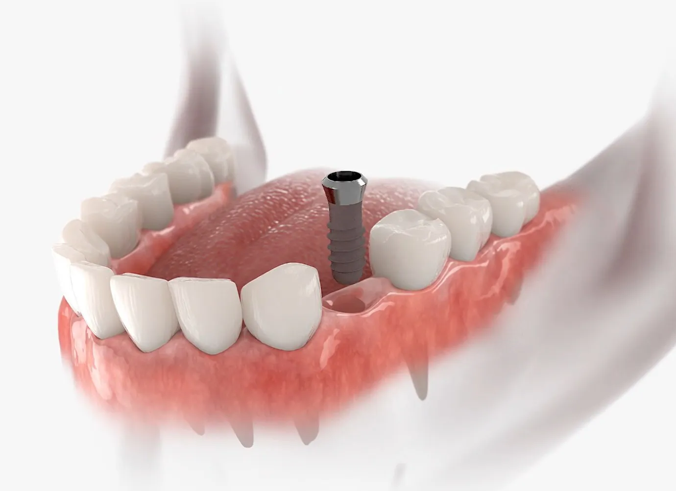 A detailed 3D illustration of the upper jaw showing a single titanium dental implant post surgically placed in the gum and bone, surrounded by natural teeth awaiting the attachment of a dental crown.