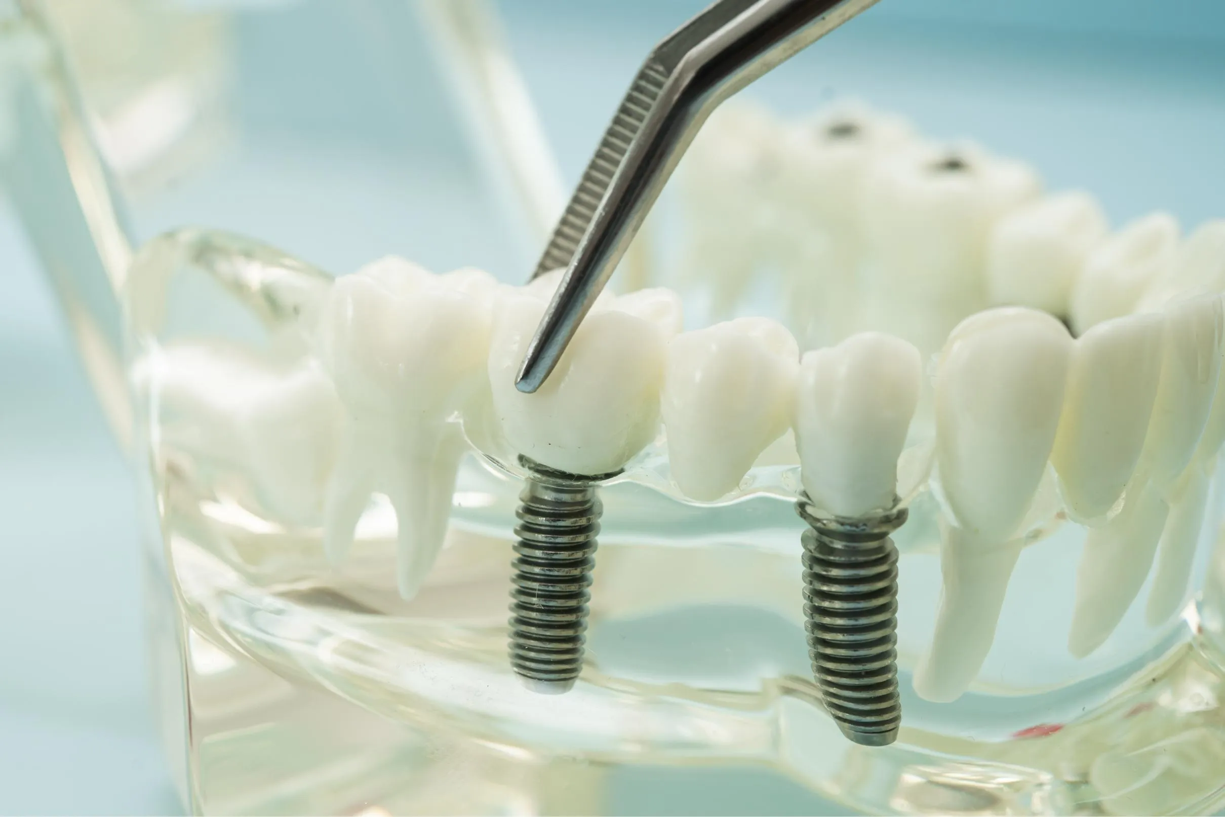 A pair of dental tweezers positions a ceramic crown onto two titanium dental implants in a clear jaw model to demonstrate implant-supported restorations.