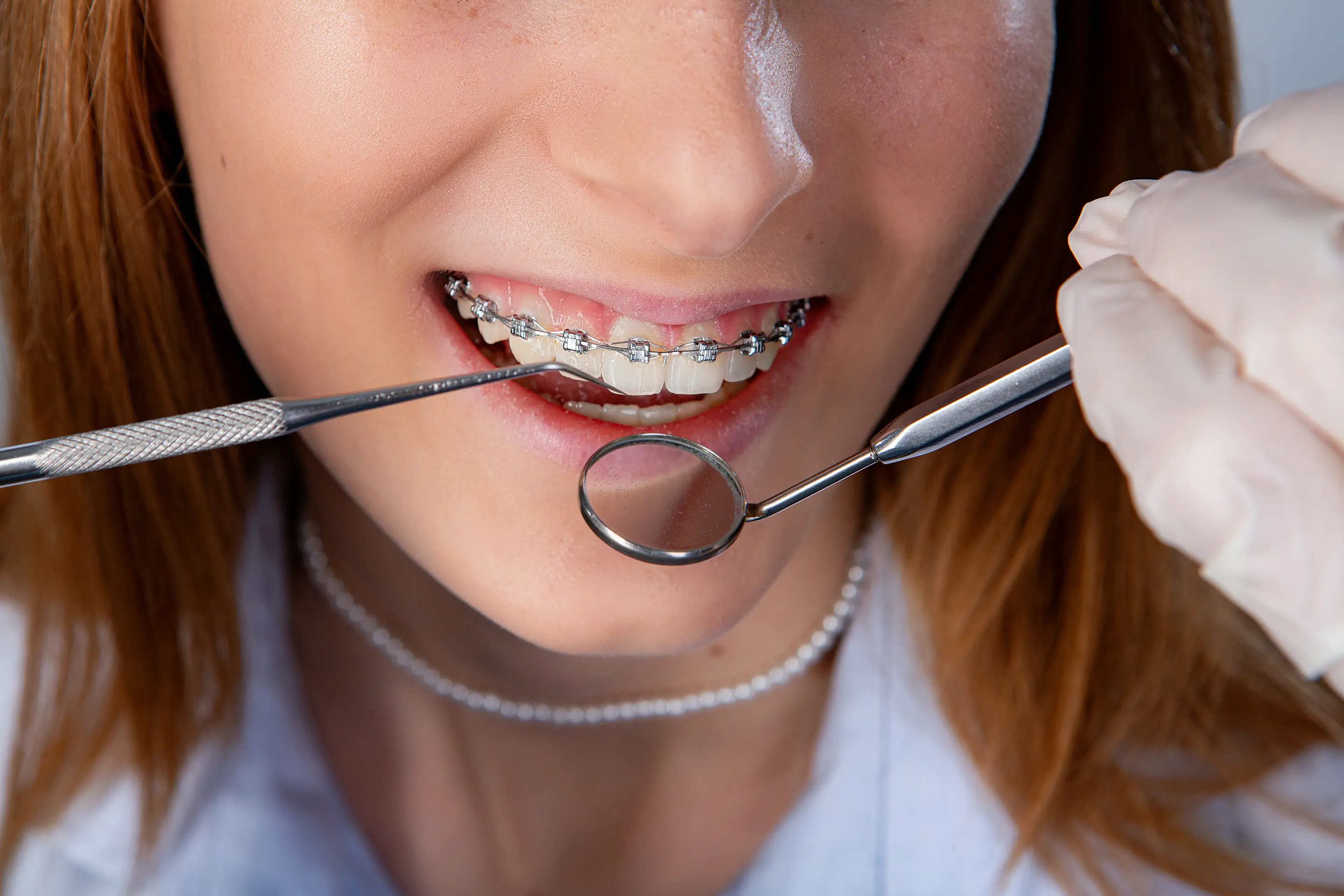 A close-up of a patient with metal braces as a dental professional uses an orthodontic mirror to check the alignment of the brackets and archwire.