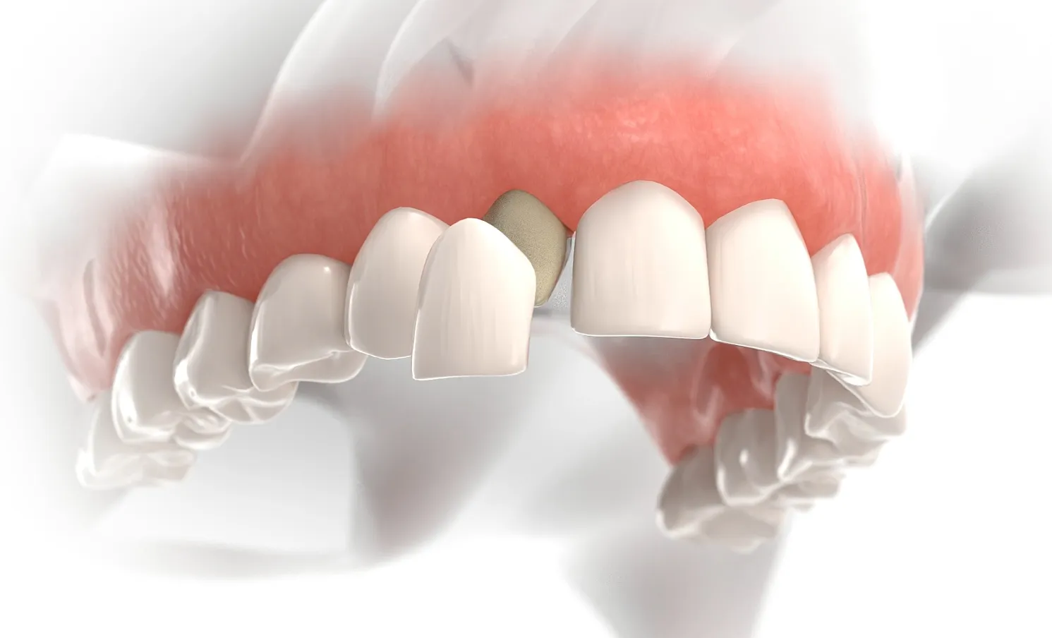 A digital illustration of the upper front teeth showing a cosmetic dental restoration being placed, with a replacement tooth positioned between natural teeth to enhance the appearance of the patient’s smile.