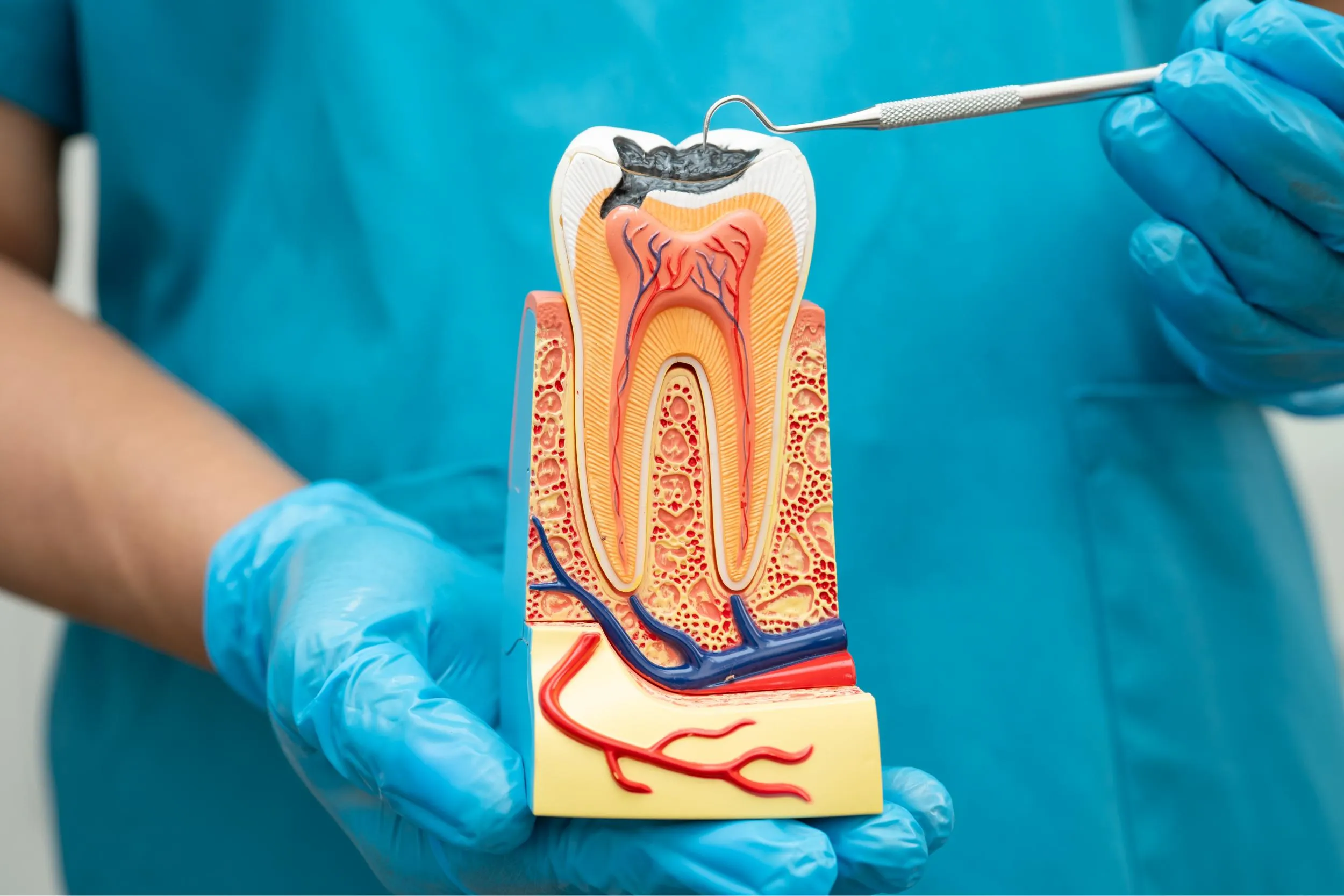 A dental professional wearing blue gloves holding a cross-section tooth model, showing the enamel, dentin, and inflamed pulp chamber to explain how root canal therapy removes infected tissue.