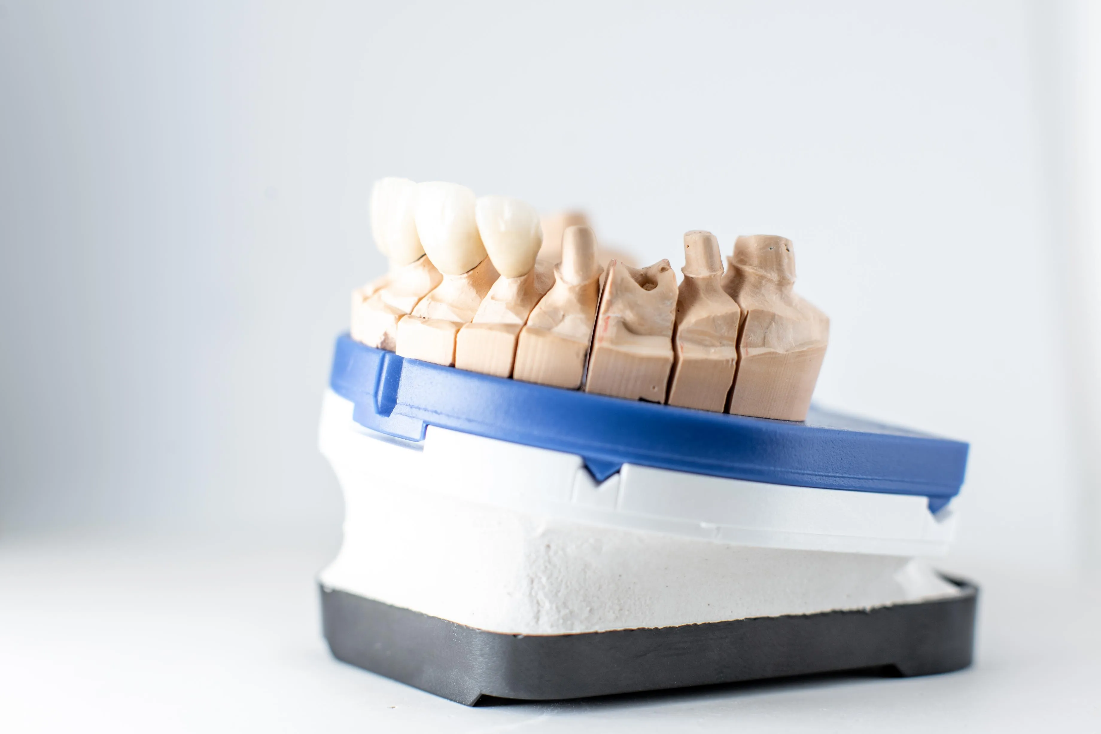 A dental crown model showing several ceramic crowns fitted over prepared teeth on a simulated upper arch, displayed on a layered base to demonstrate how crowns restore damaged tooth structure.
