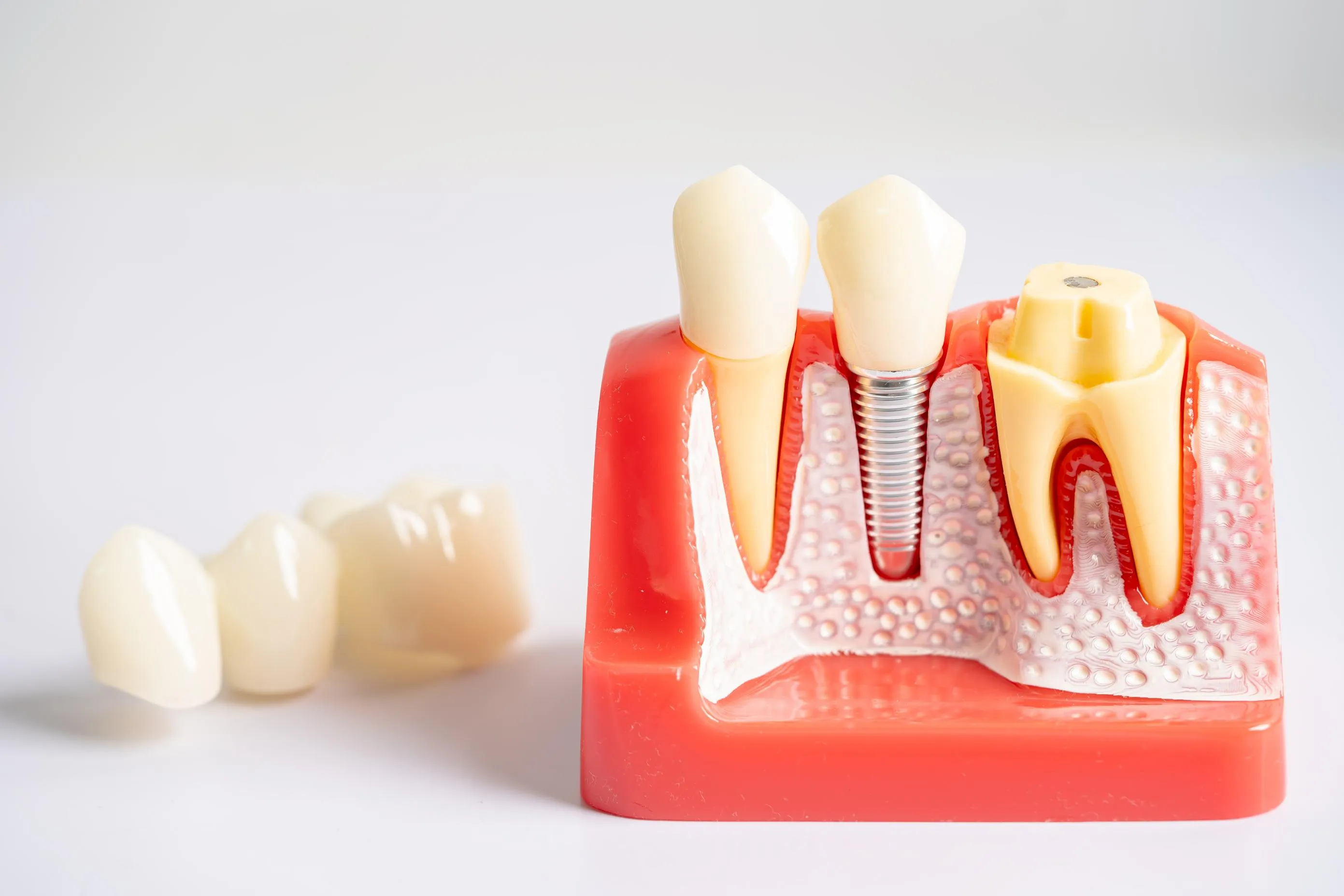A cross-section anatomical model illustrating a natural tooth beside a tooth prepared for a crown, showing the enamel reduction and the placement of a ceramic crown over the tooth structure.