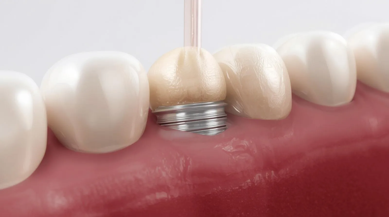 A dental crown being secured onto a titanium implant post embedded in the gum tissue, illustrating the final step of implant restoration as the crown is placed and tightened into position.