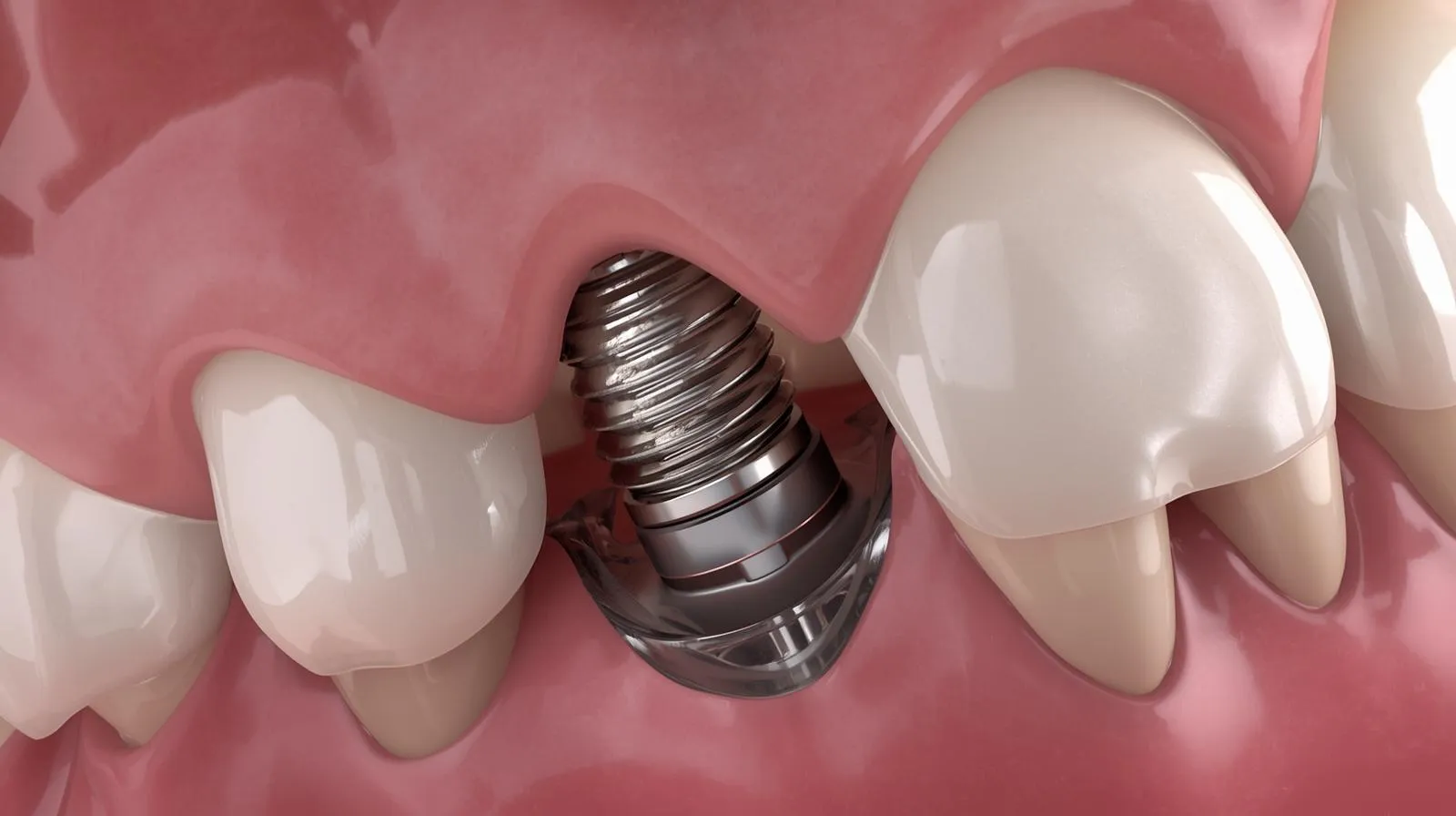 A detailed illustration of a titanium dental implant placed in the jawbone beneath the gums, shown between two natural teeth to demonstrate how implant posts support replacement crowns in implant restoration procedures.