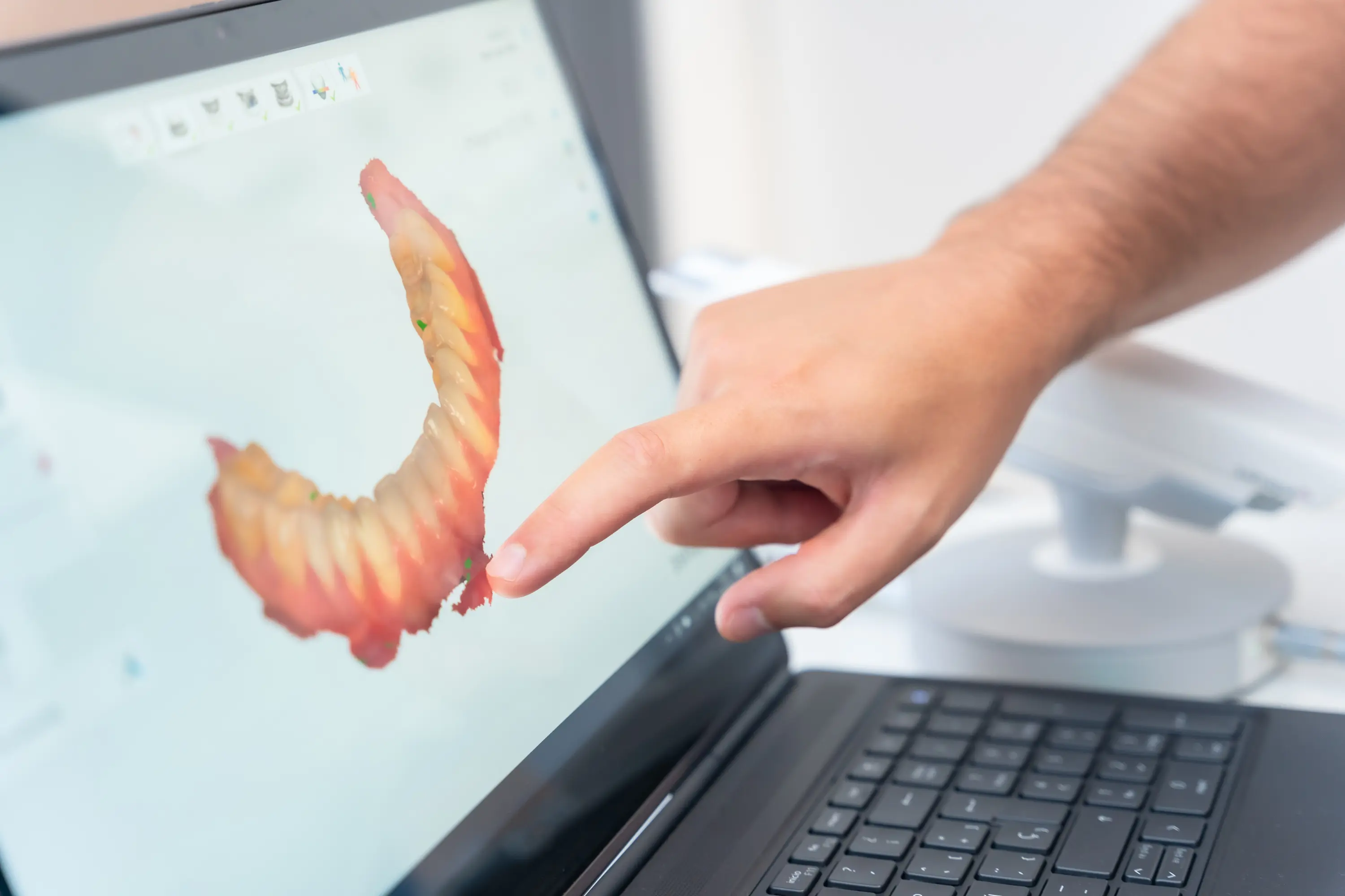 A dentist’s hand pointing at a detailed 3D digital scan of a patient’s upper jaw on a computer screen, showing bone structure and gum contours used for computer-guided dental implant planning.