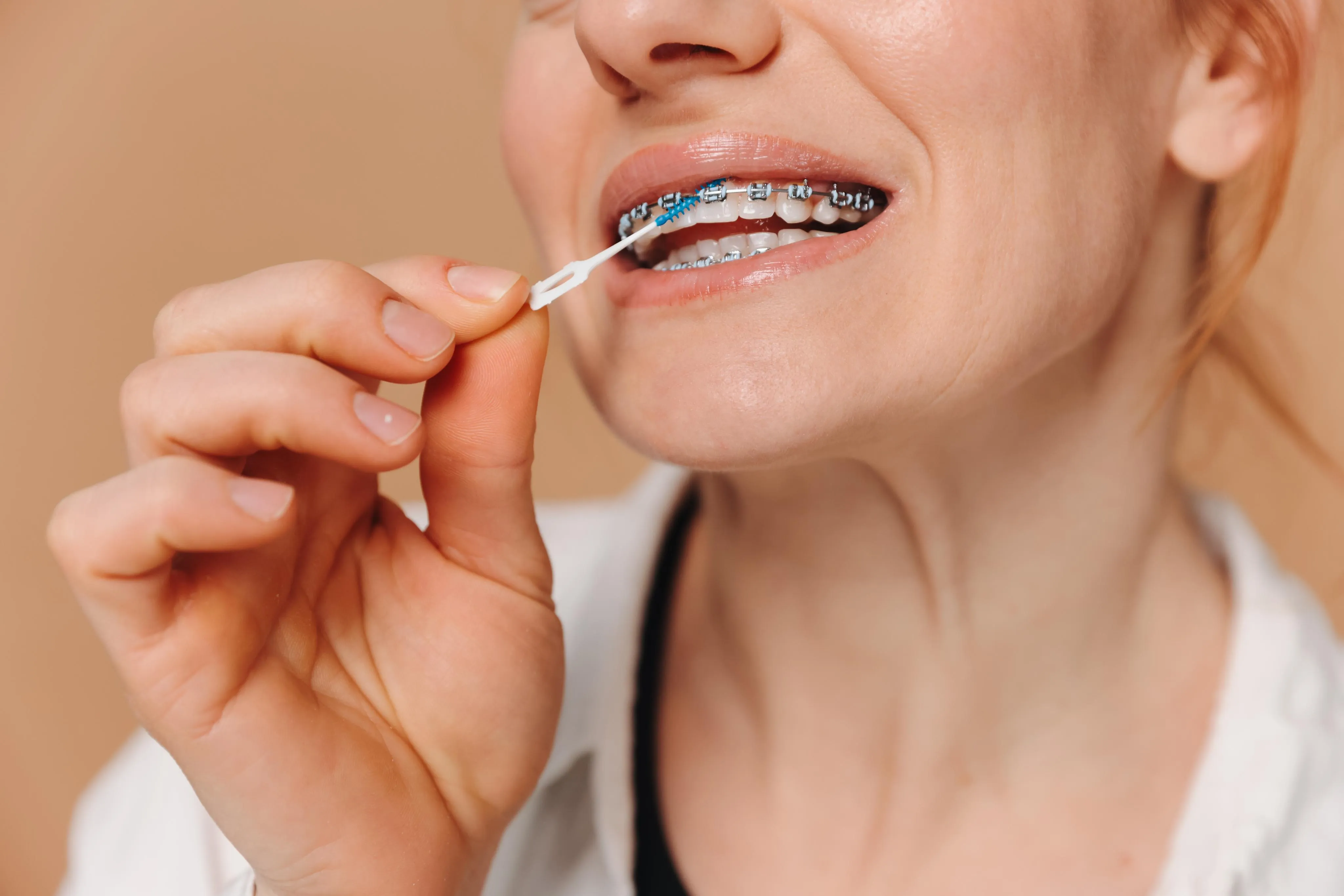 A close-up of a woman cleaning her metal braces with an interdental brush, showing the brackets and archwire as she removes plaque from between the orthodontic components.