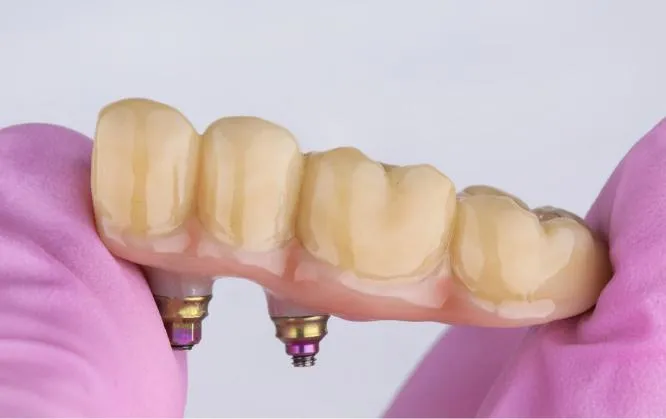 Close-up of gloved hands holding a four-unit implant-supported dental bridge, highlighting the realistic tooth shading and dual screw-retained connectors on the underside of the restoration.