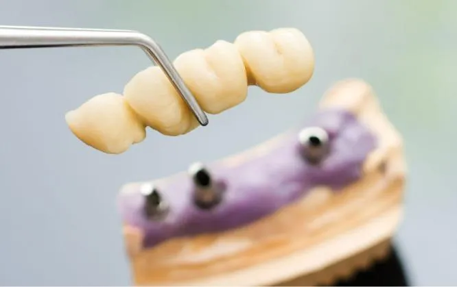 A ceramic multi-unit dental bridge being held with tweezers over a stone model covered with purple gingival impression material, showing three exposed implant abutments ready to receive the restoration.