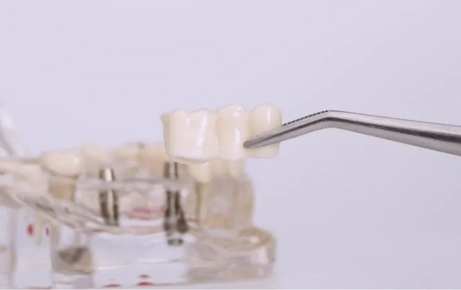 A dental professional uses tweezers to position a three-unit porcelain dental bridge above a transparent acrylic jaw model that shows multiple titanium implant posts used for implant-supported bridges.