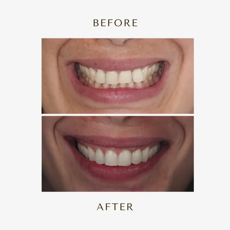 Caso real: sonrisa antes y después de un tratamiento de estética dental