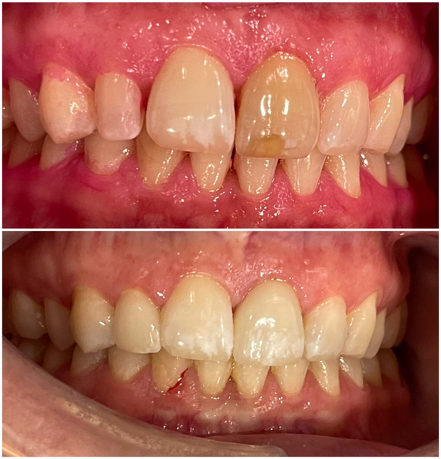 1 Porcelain Crown + 1 Porcelain Veneer