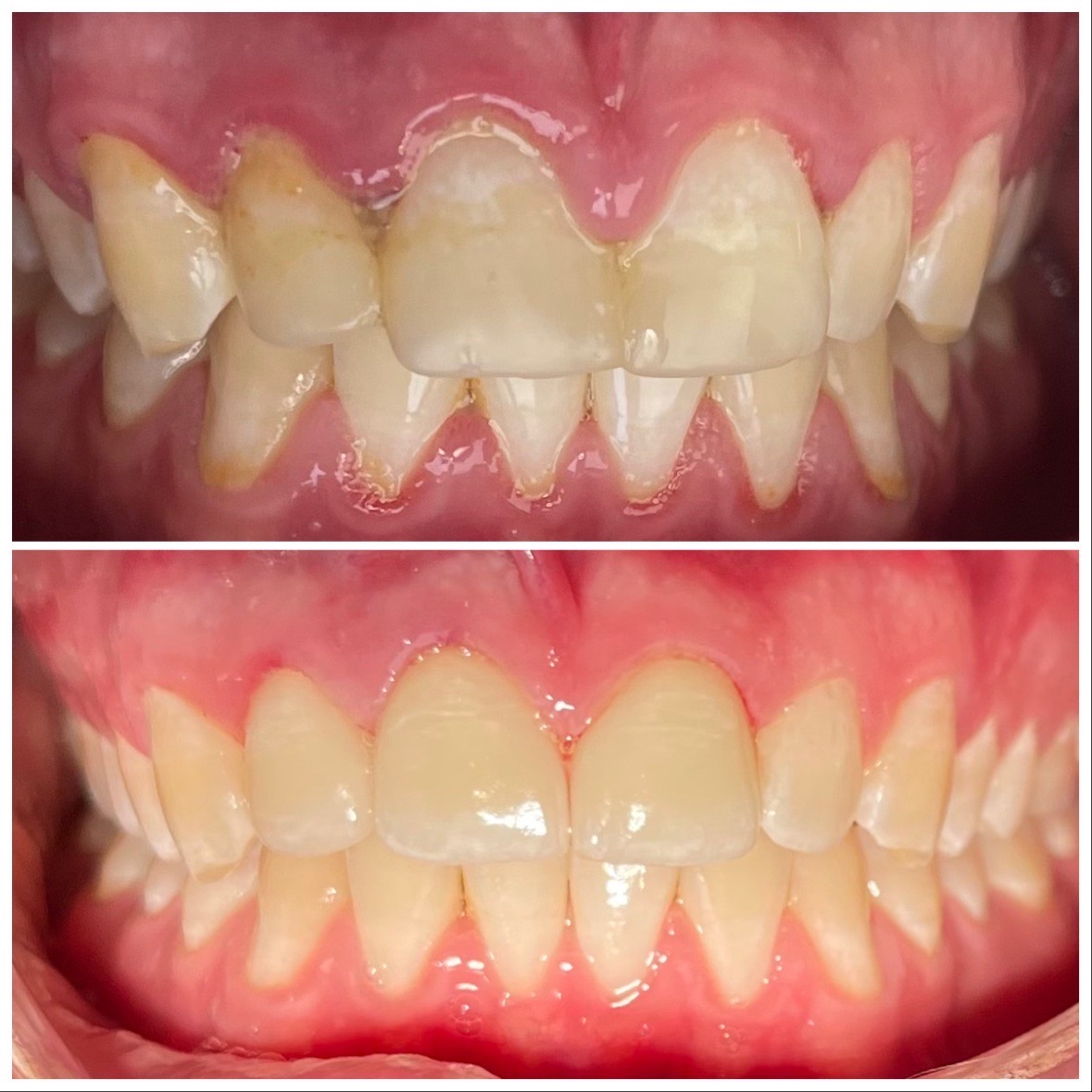 3 Front Porcelain Crowns