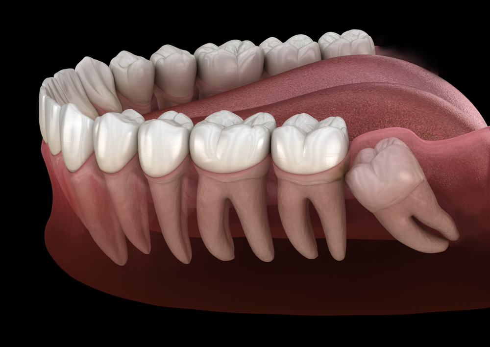 3d model of impacted wisdom tooth