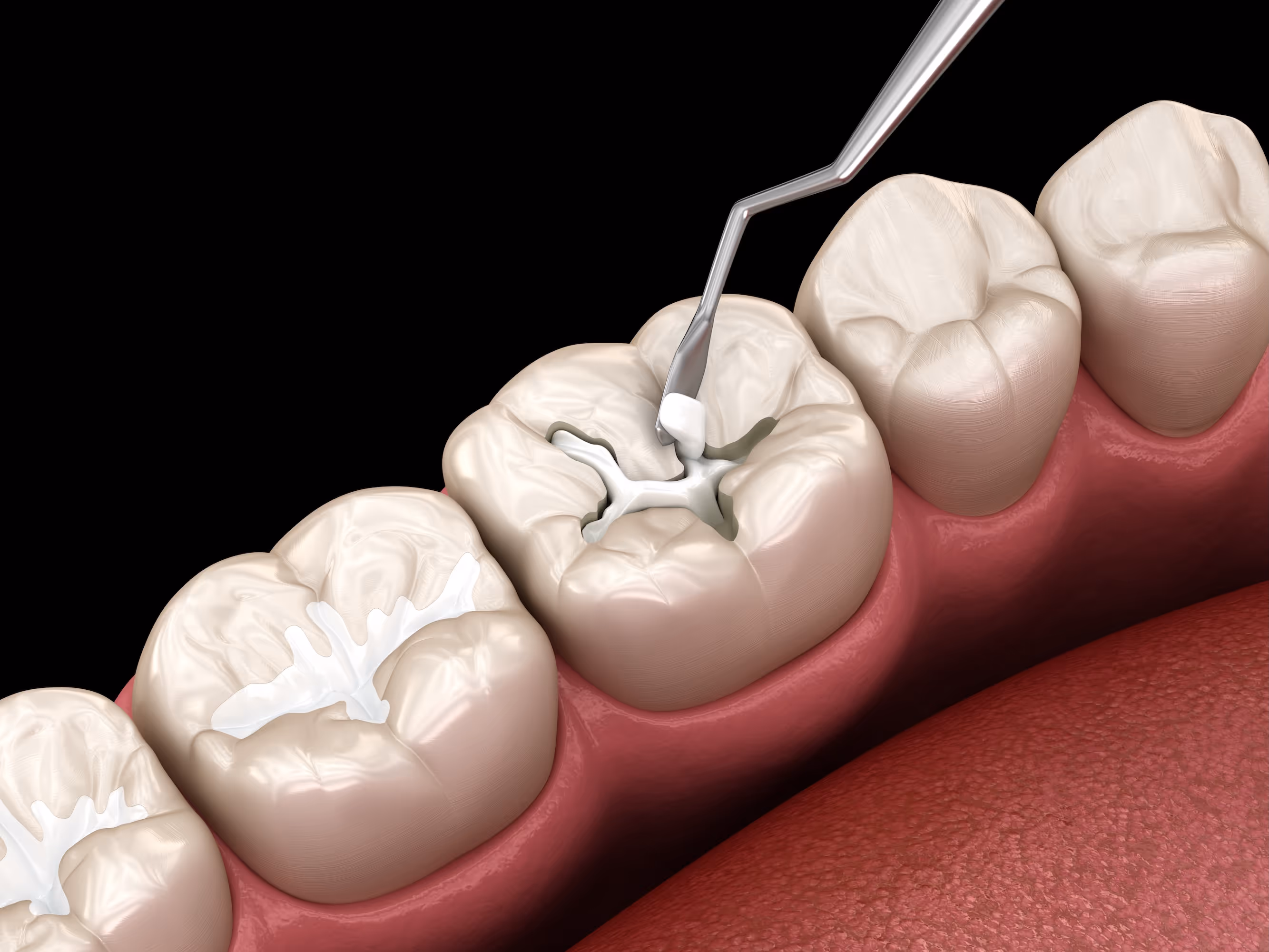 Close-up of dental filling procedure – repairing decayed teeth for a healthy smile