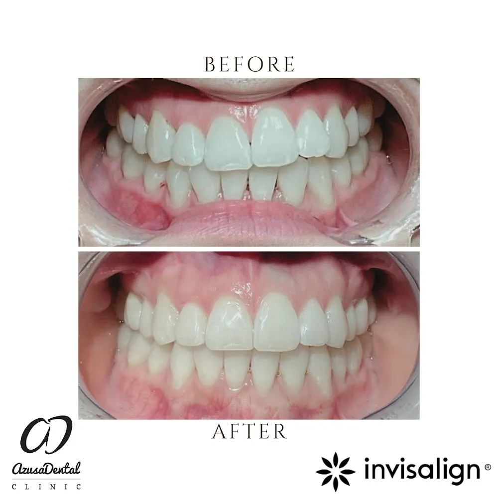 Before and after photos showing teeth alignment improvement with Invisalign treatment from Azusa Dental Clinic.