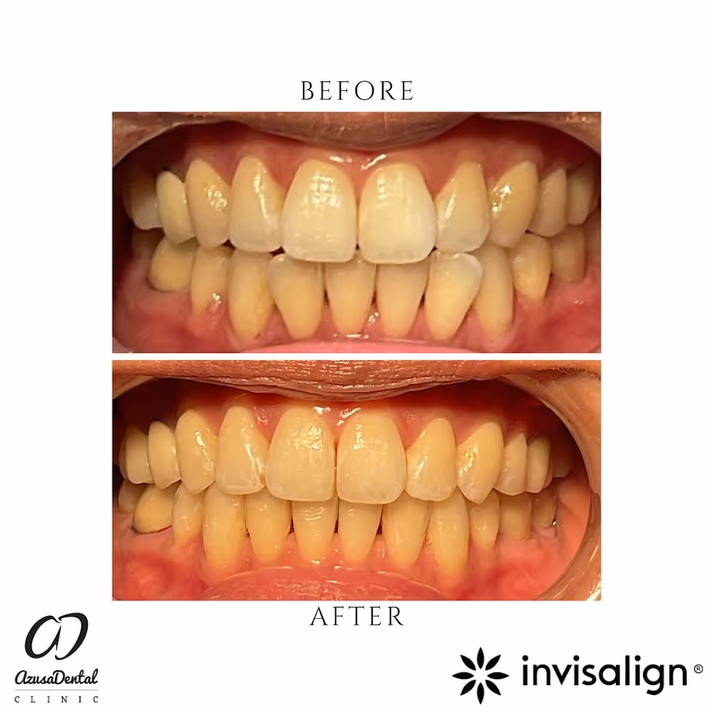 Before and after close-up images showing dental teeth alignment improvement with Invisalign treatment.