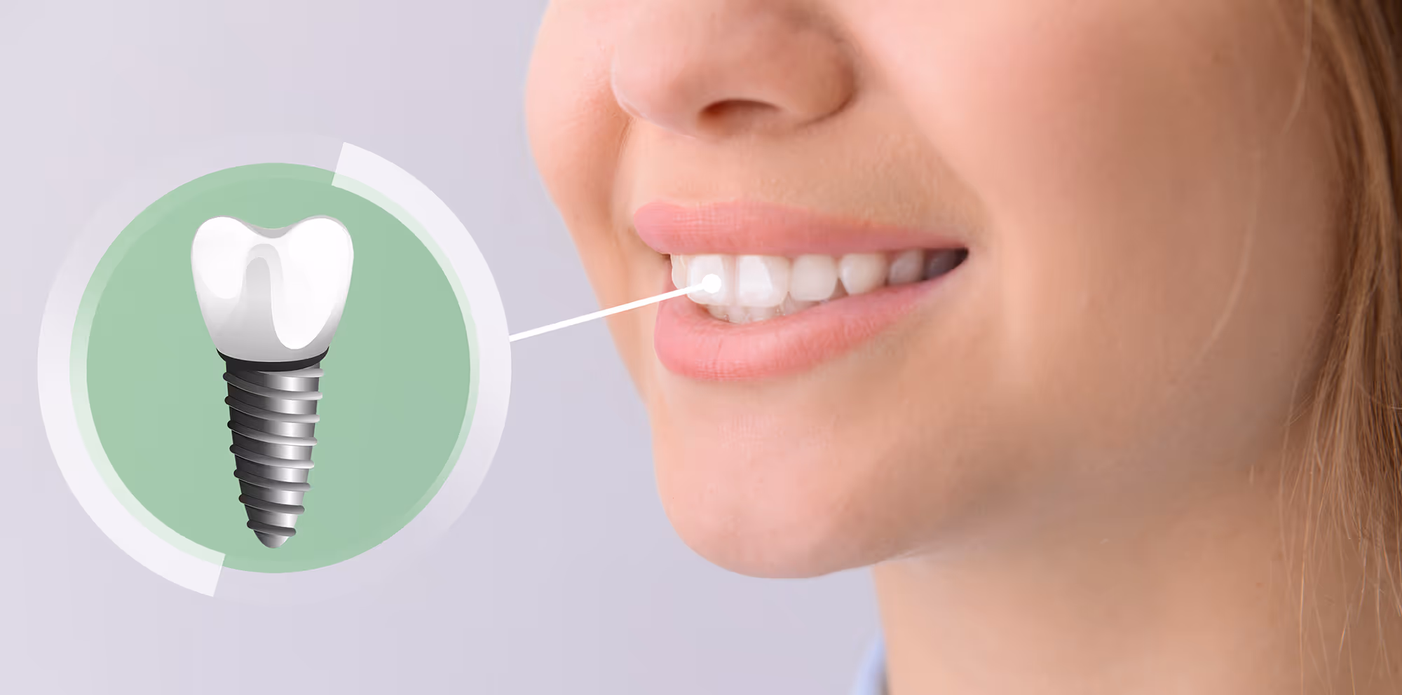 Implant placement and restoration banner dental clinic